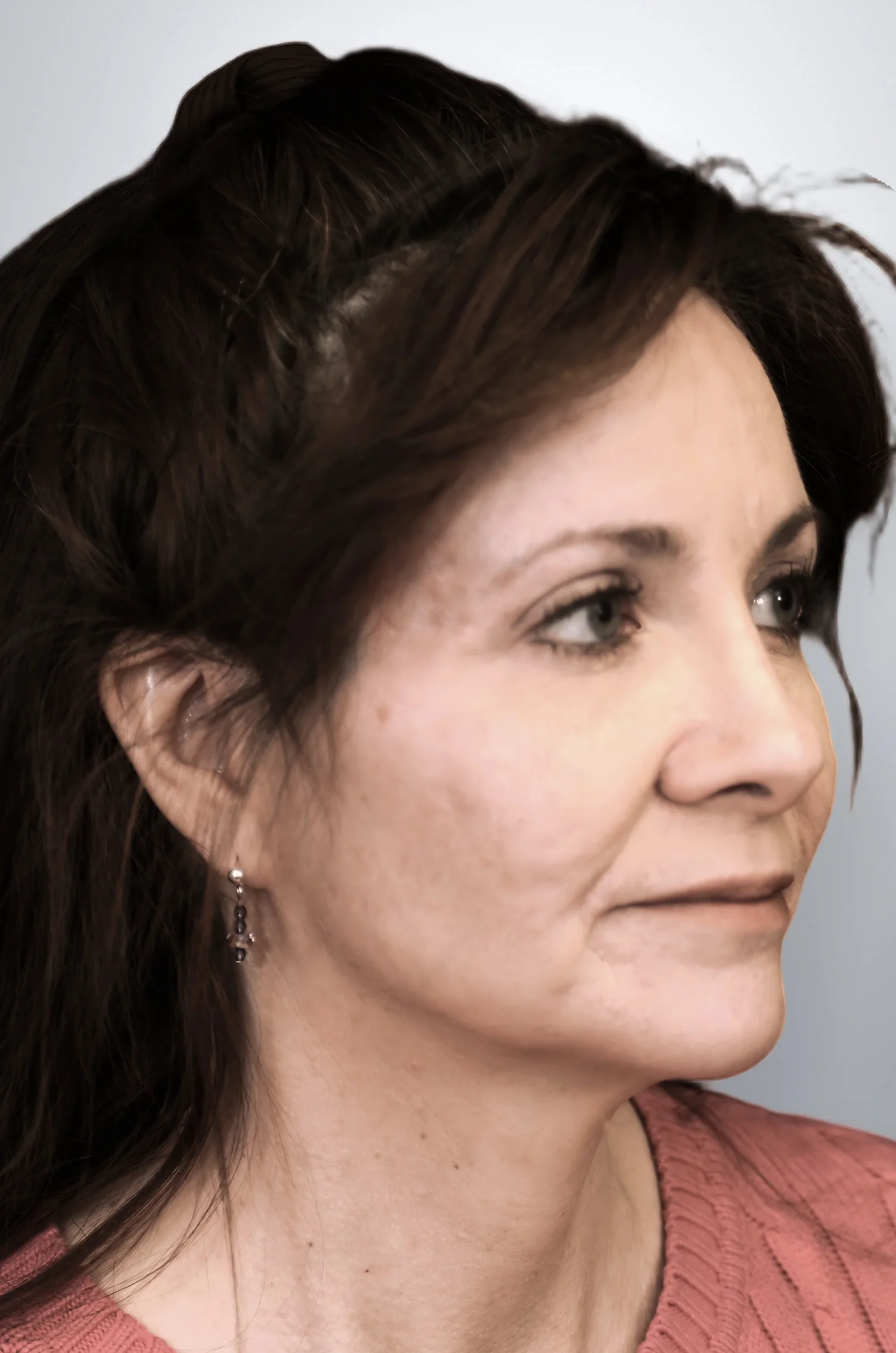 Blepharoplasty after, Edition Plastic Surgery patient