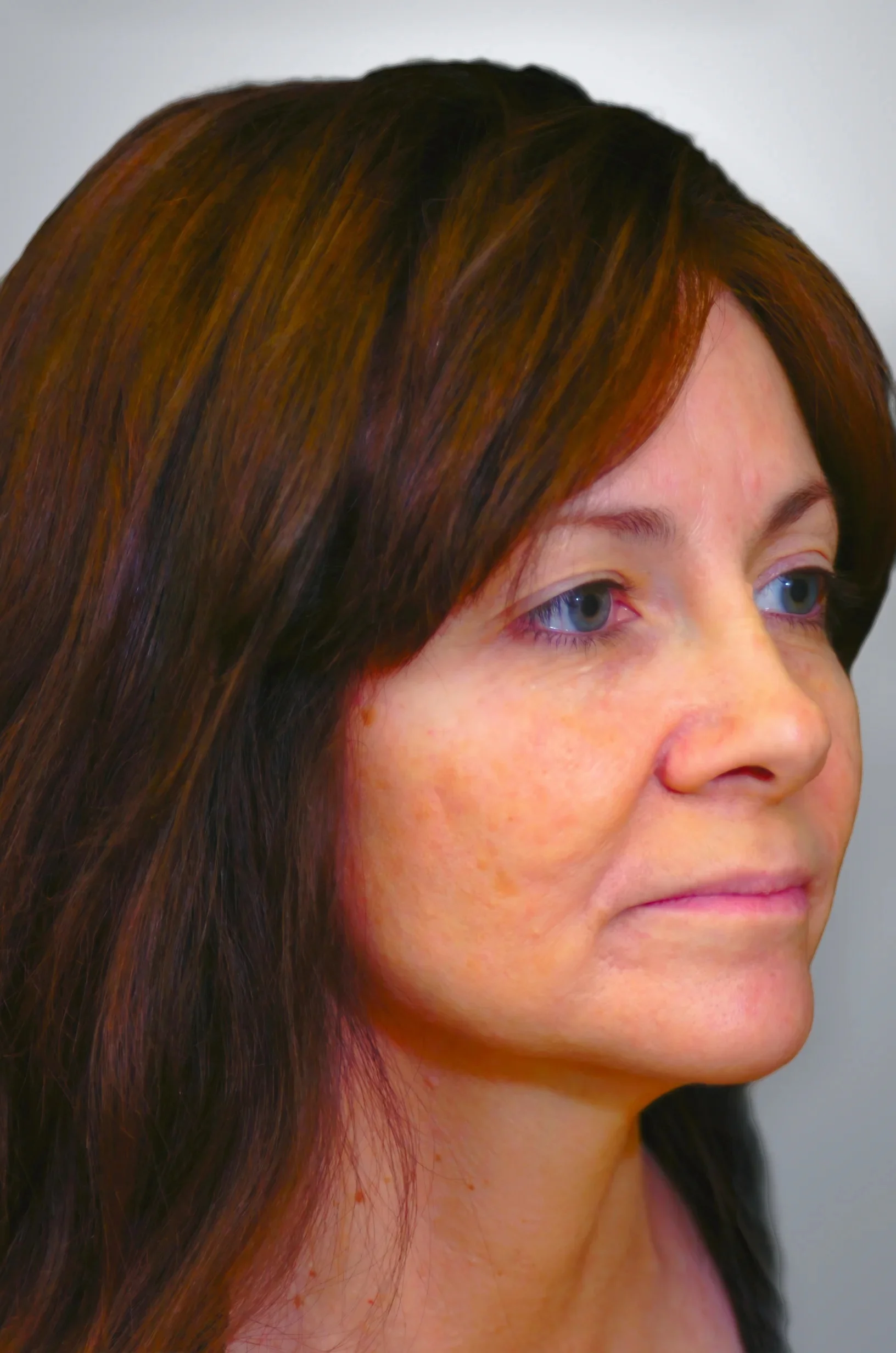 Blepharoplasty before, Edition Plastic Surgery patient