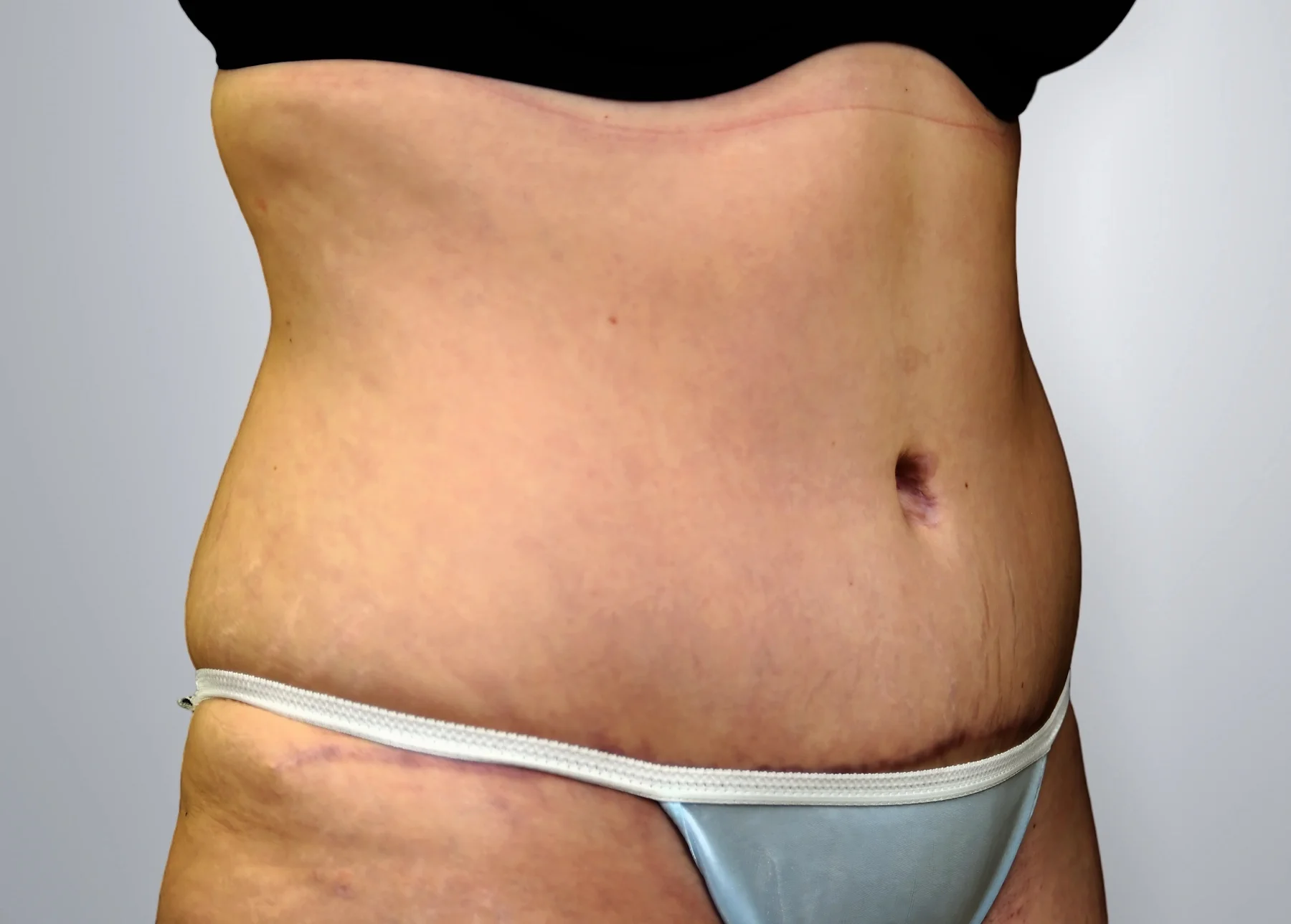 Liposuction + Tummy Tuck after, Edition Plastic Surgery patient
