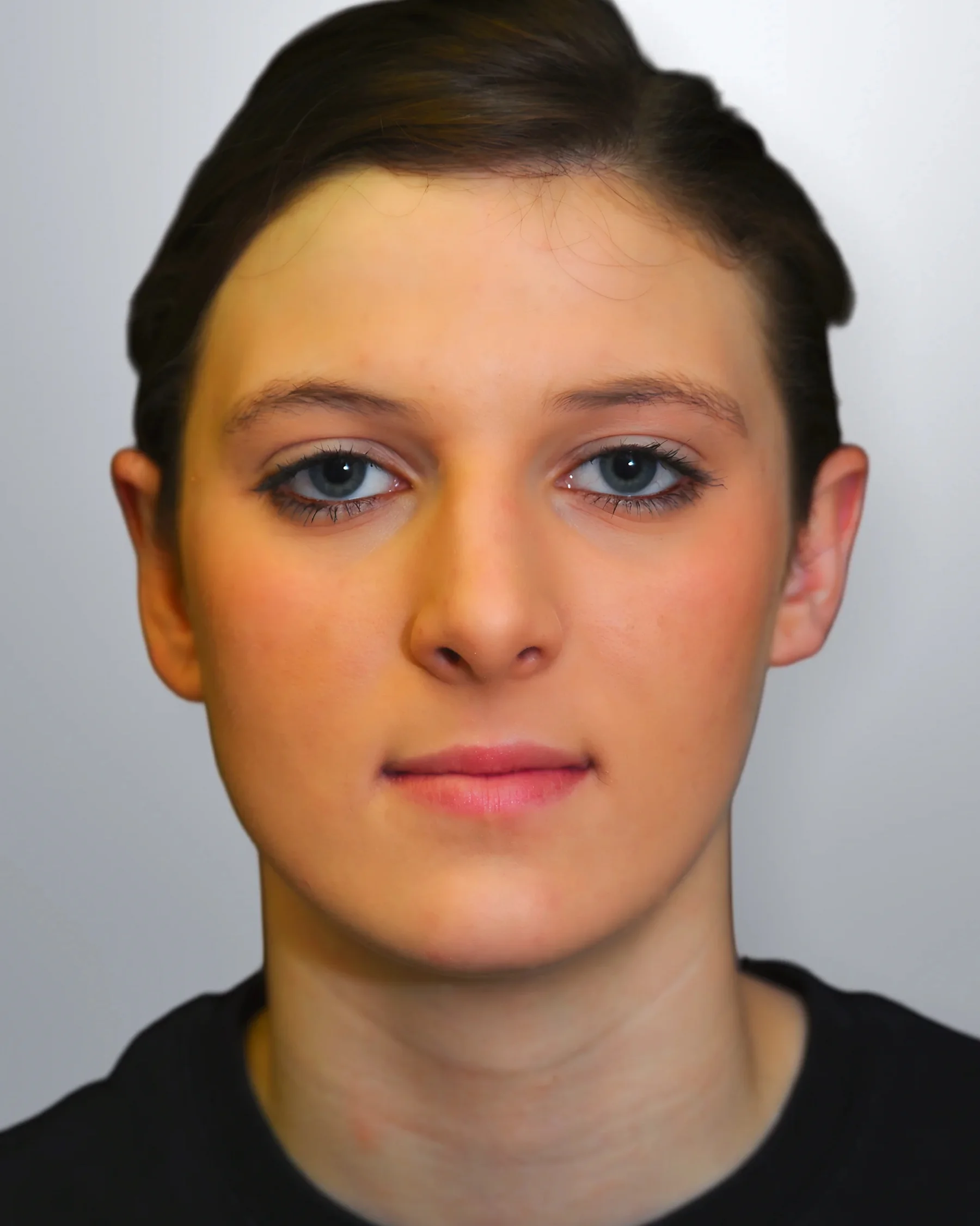 Otoplasty after, Edition Plastic Surgery patient