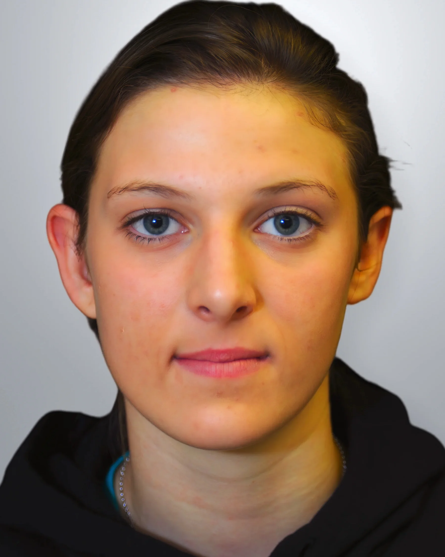 Otoplasty before, Edition Plastic Surgery patient