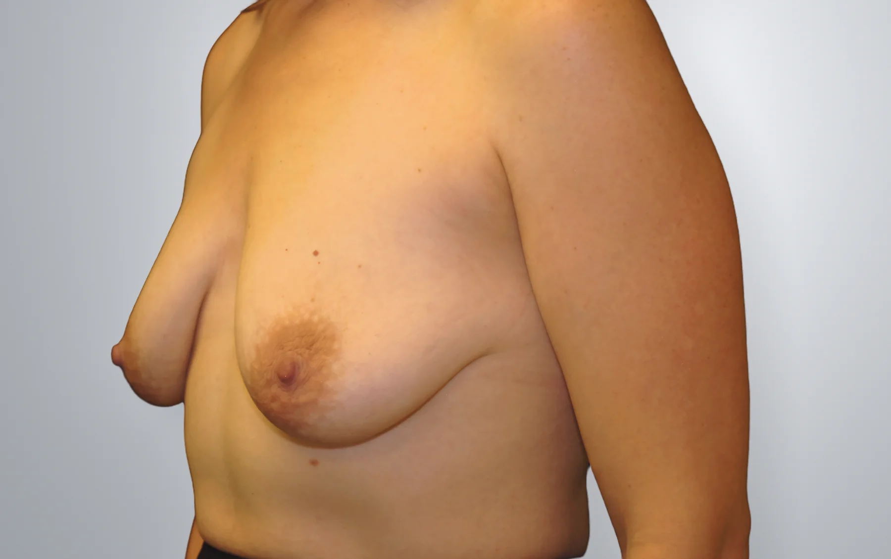 Breast Augmentation + Breast Lift before, Edition Plastic Surgery patient