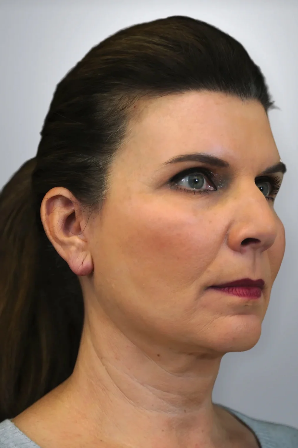 Neck Lift + Midface Lift + Facelift after, Edition Plastic Surgery patient