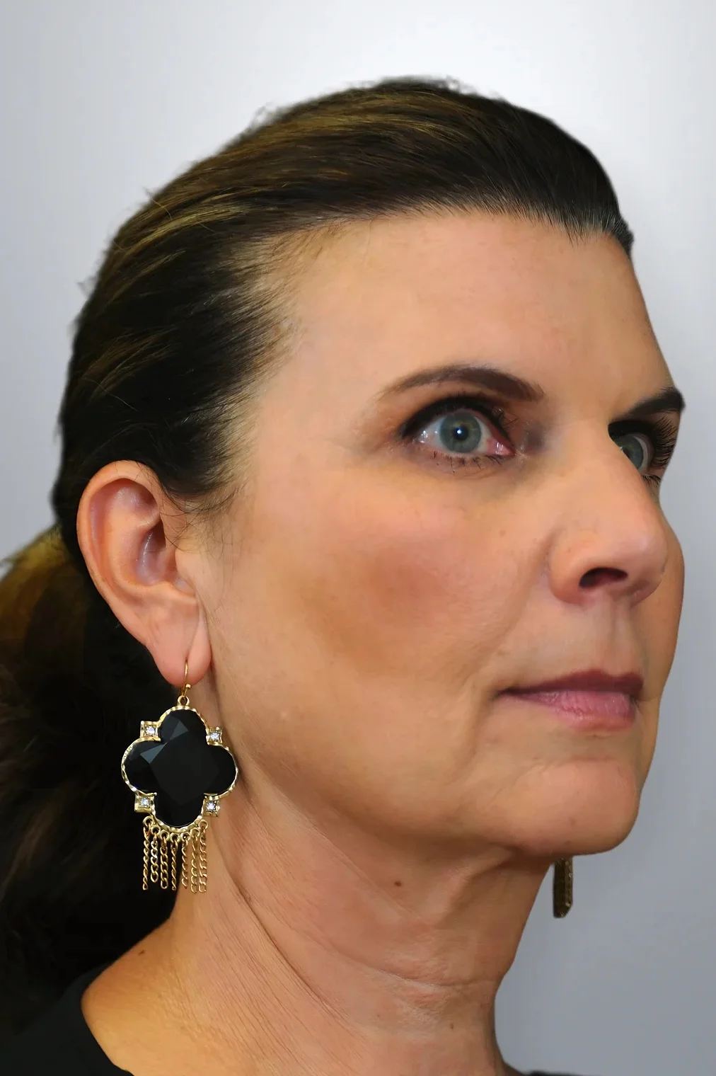 Neck Lift + Midface Lift + Facelift before, Edition Plastic Surgery patient
