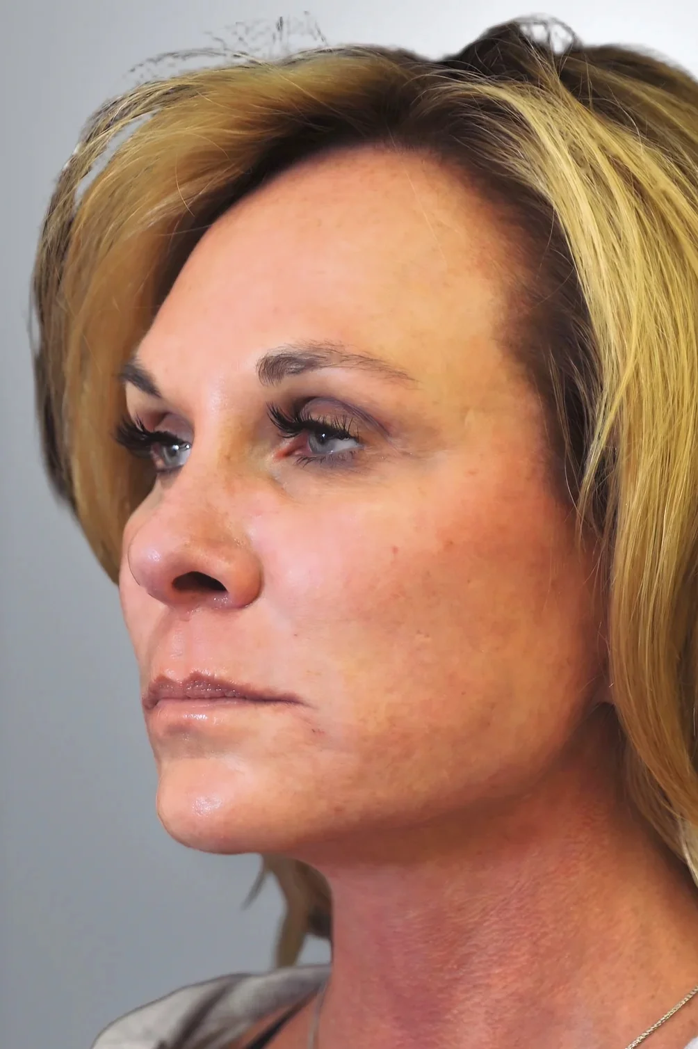 Neck Lift + Facelift + Midface Lift after, Edition Plastic Surgery patient