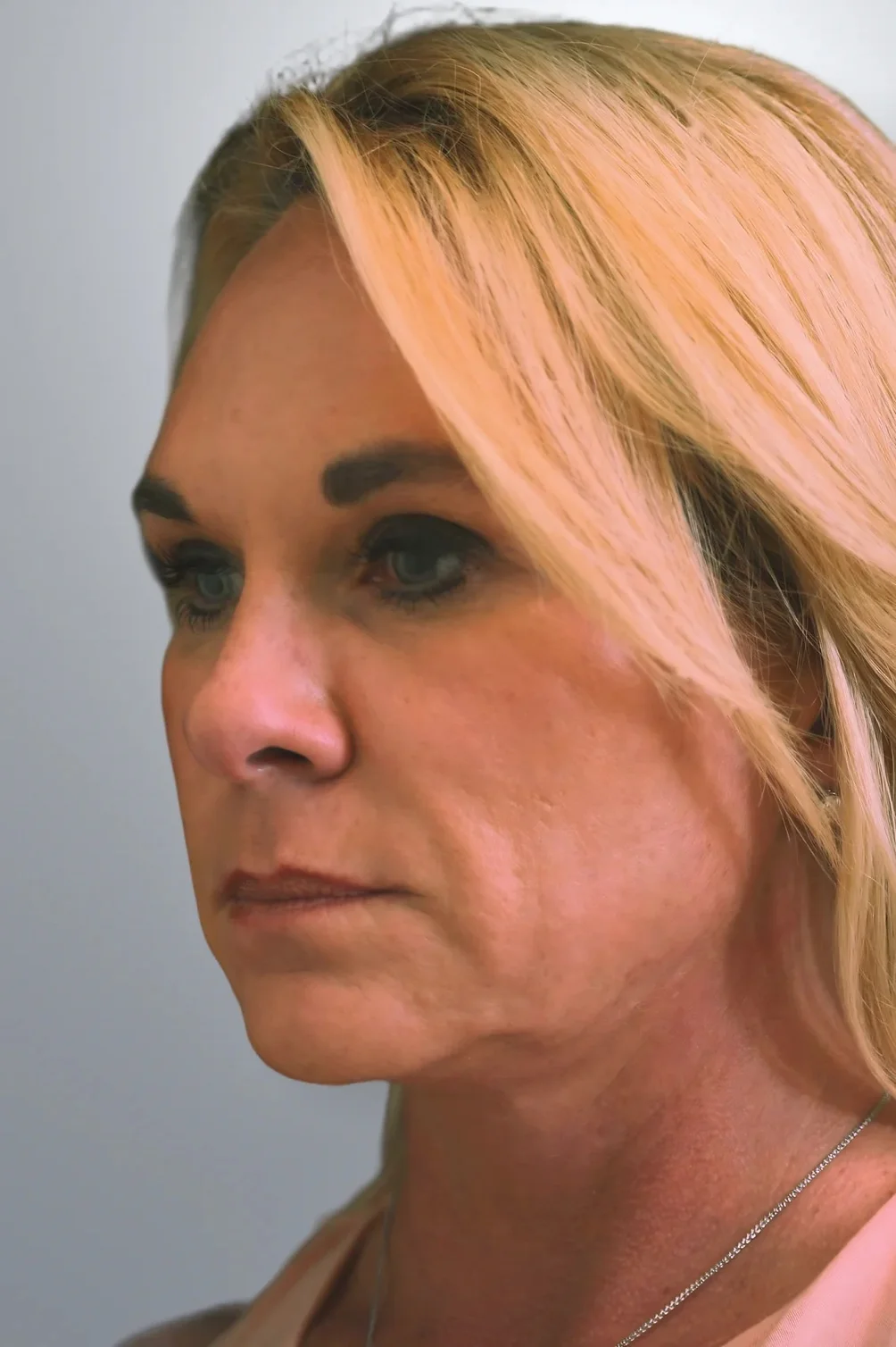 Neck Lift + Facelift + Midface Lift before, Edition Plastic Surgery patient