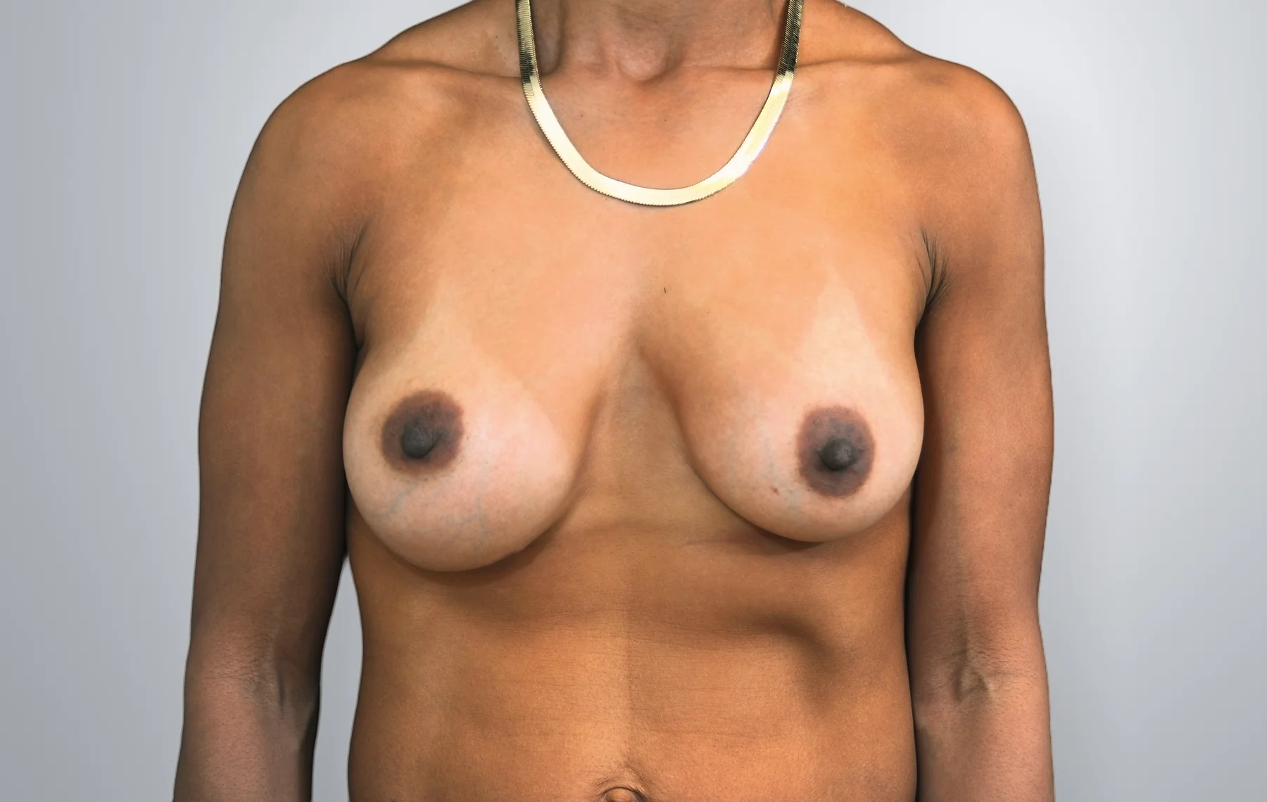 Breast Implant Revision before, Edition Plastic Surgery patient