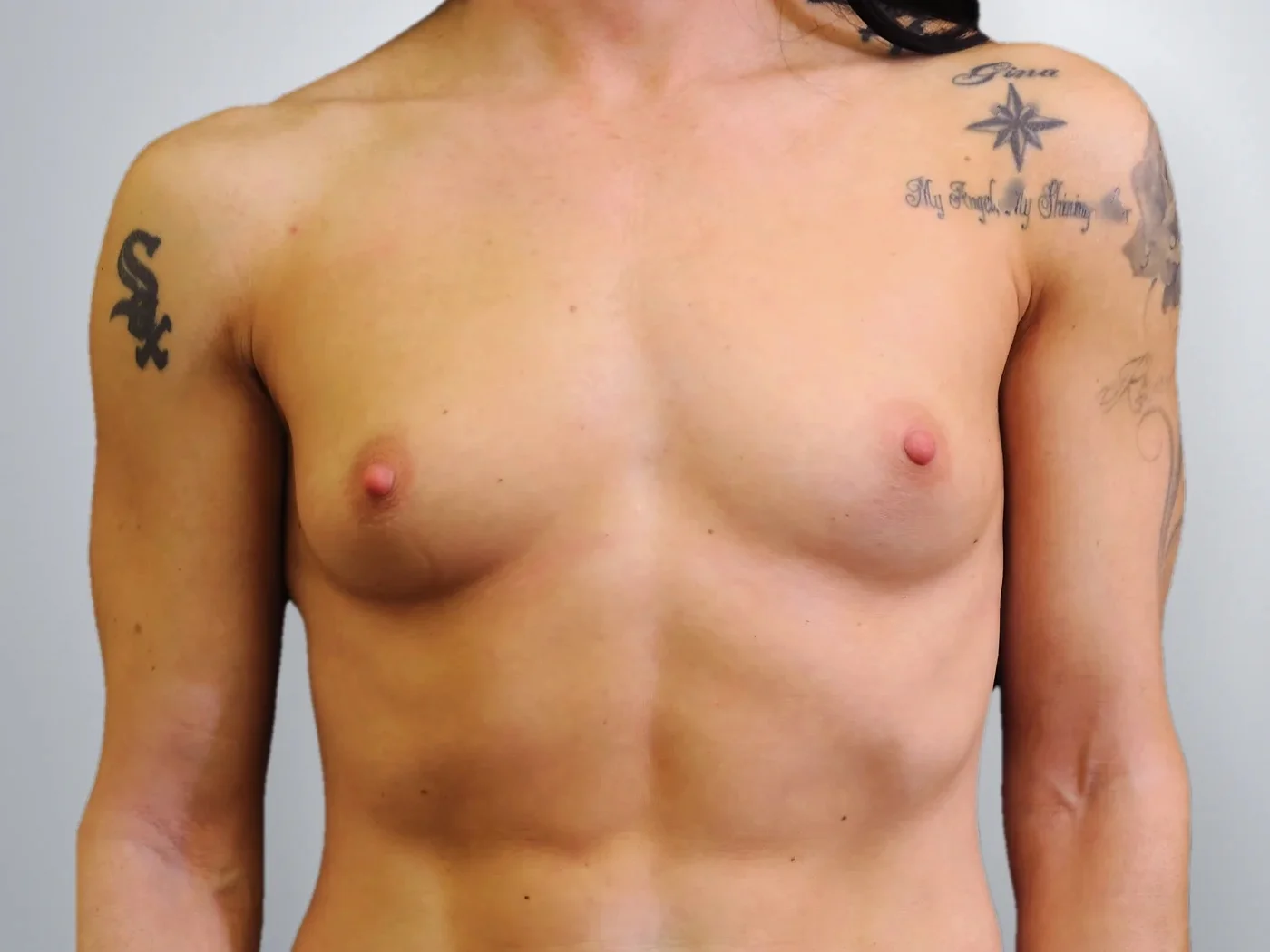 Breast Augmentation before, Edition Plastic Surgery patient