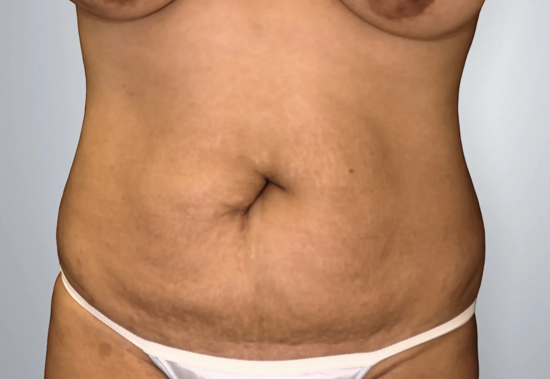 Tummy Tuck before, Edition Plastic Surgery patient