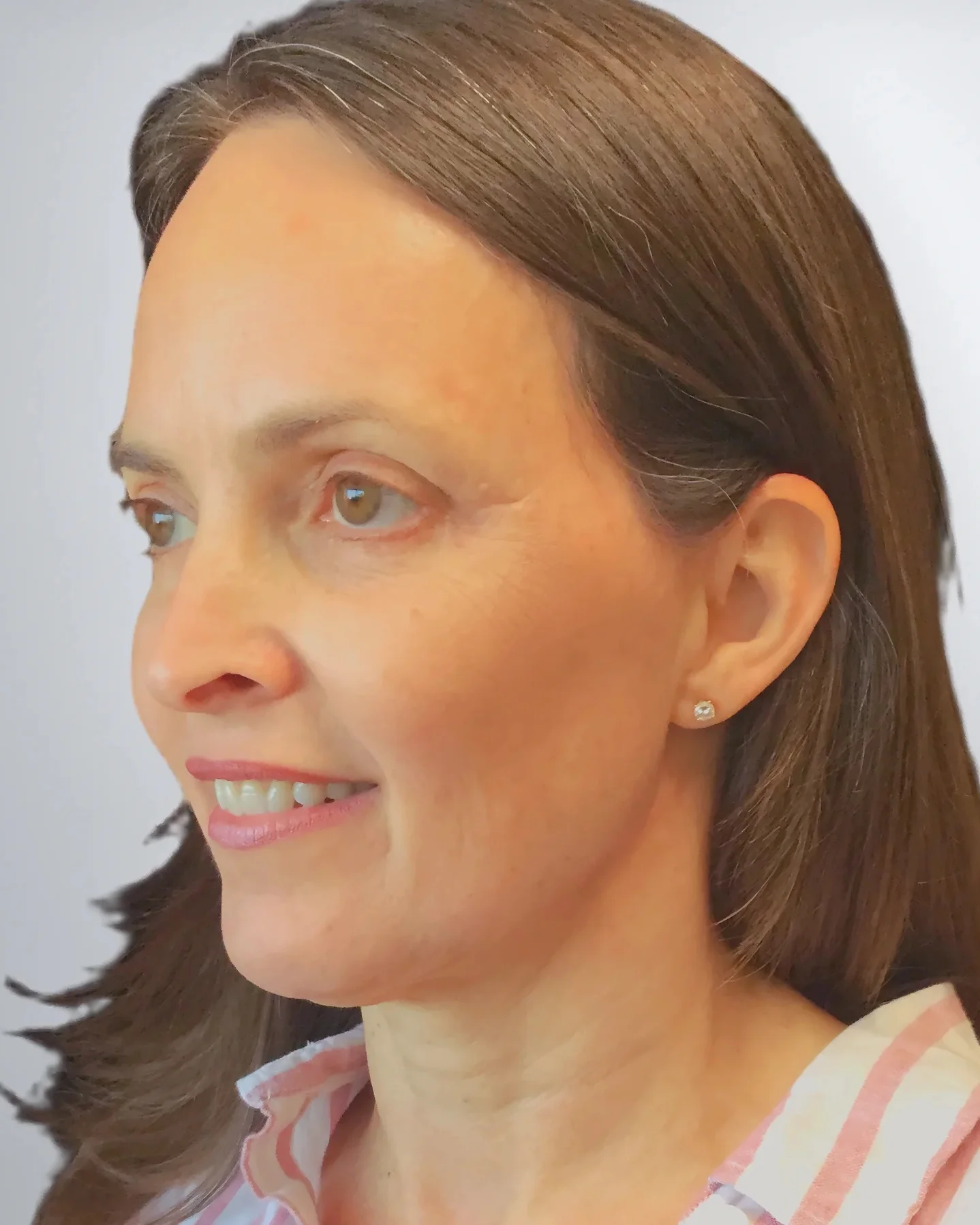 Blepharoplasty after, Edition Plastic Surgery patient