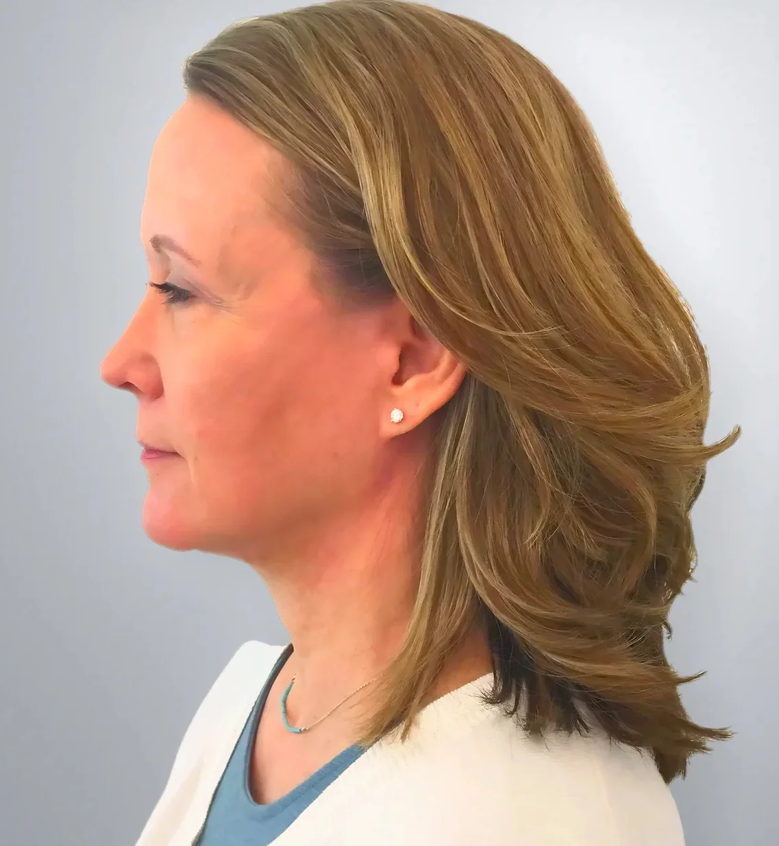 Facelift after, Edition Plastic Surgery patient