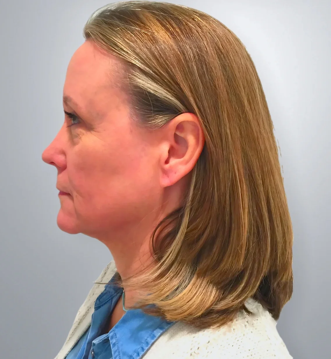 Facelift before, Edition Plastic Surgery patient