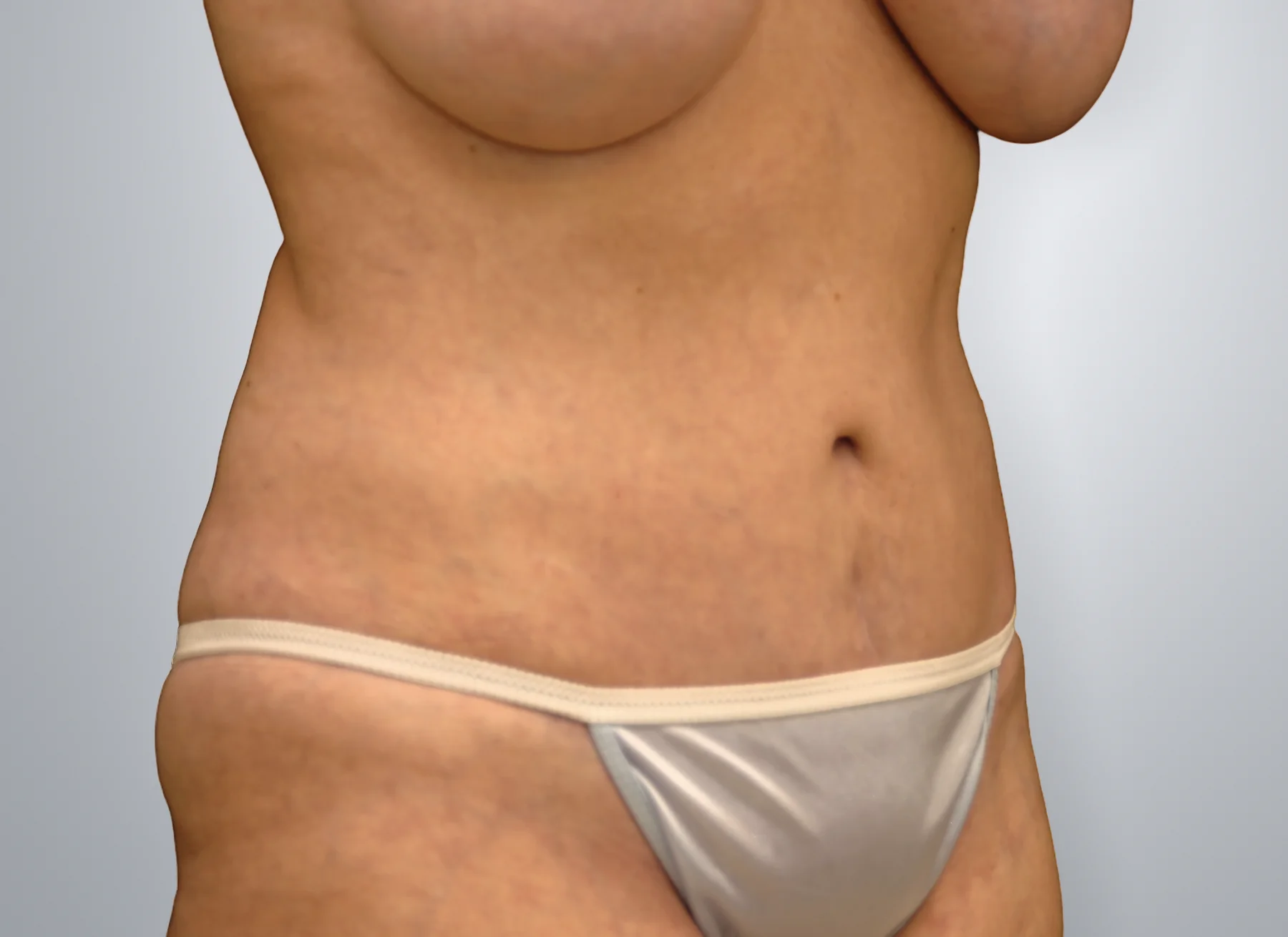 Tummy Tuck after, Edition Plastic Surgery patient