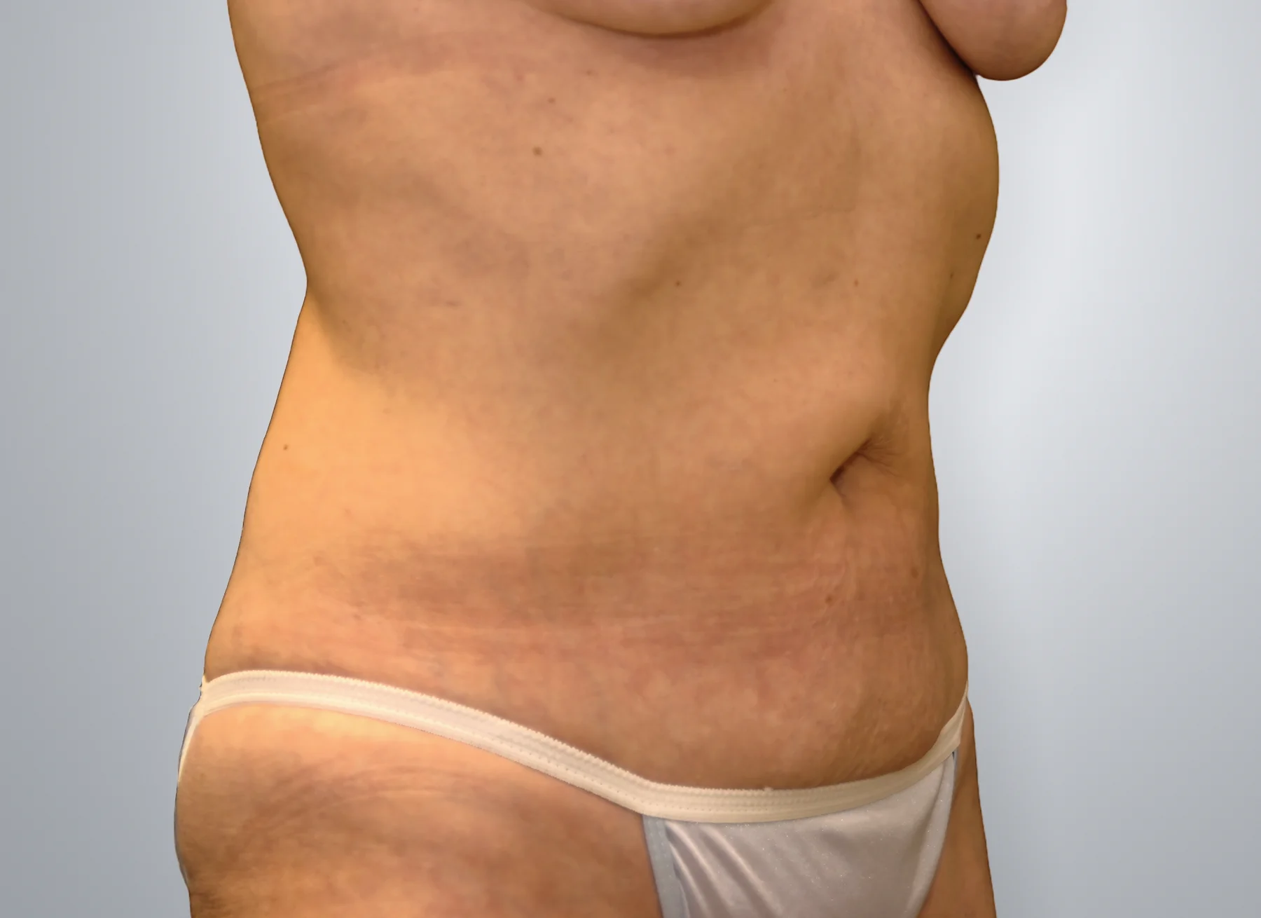 Tummy Tuck before, Edition Plastic Surgery patient