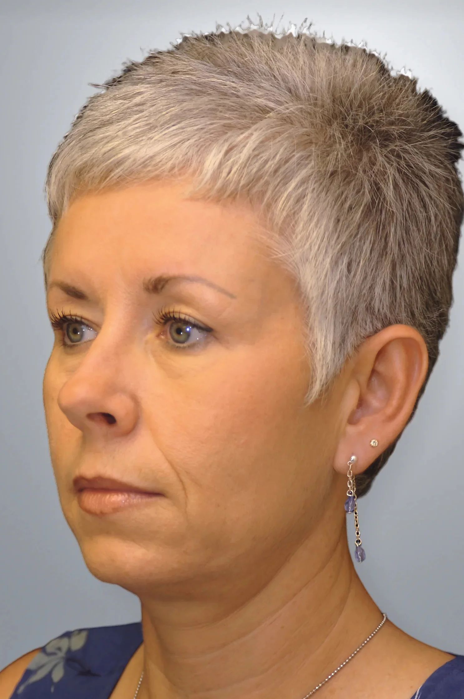 Blepharoplasty after, Edition Plastic Surgery patient