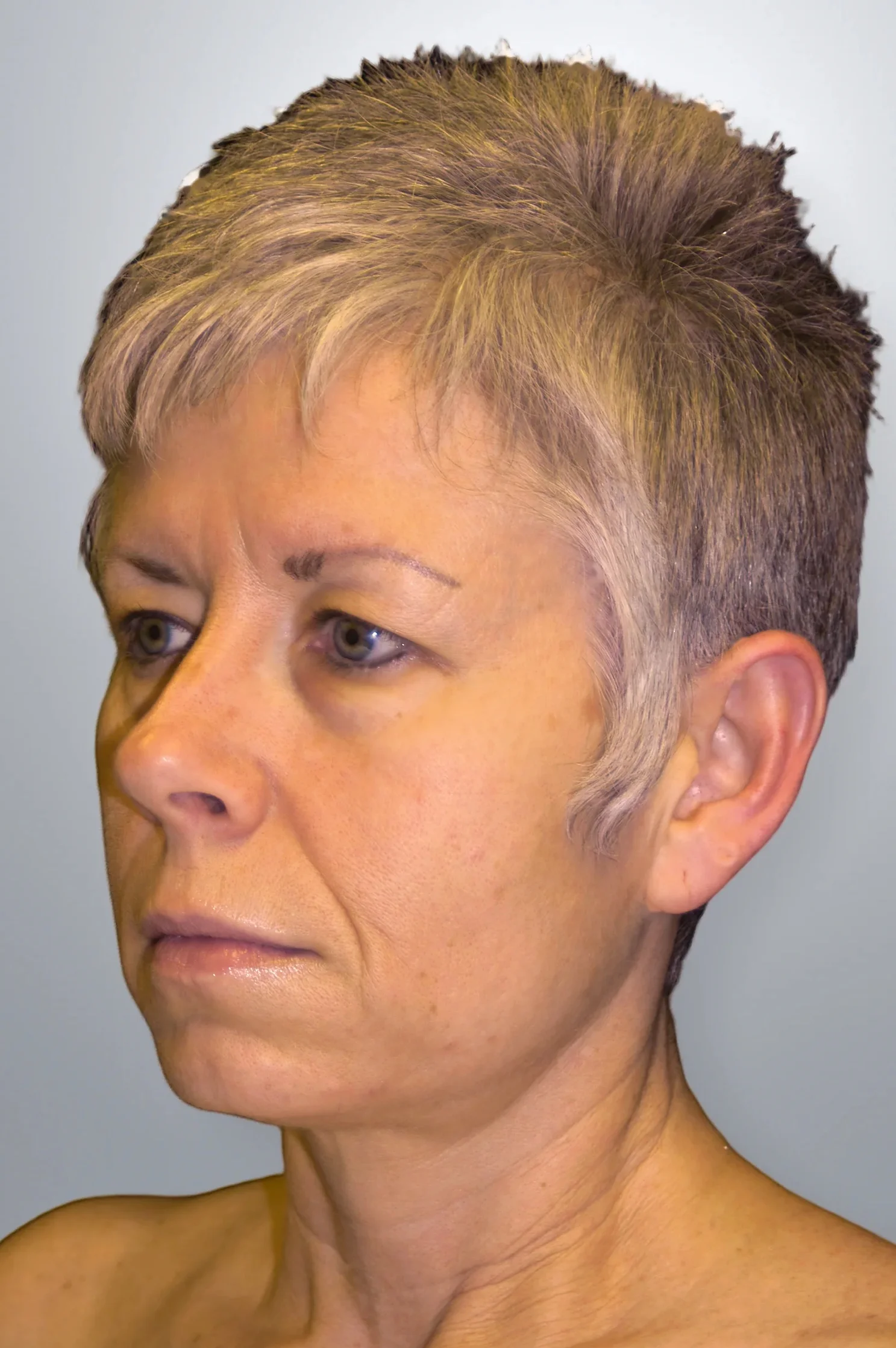 Blepharoplasty before, Edition Plastic Surgery patient