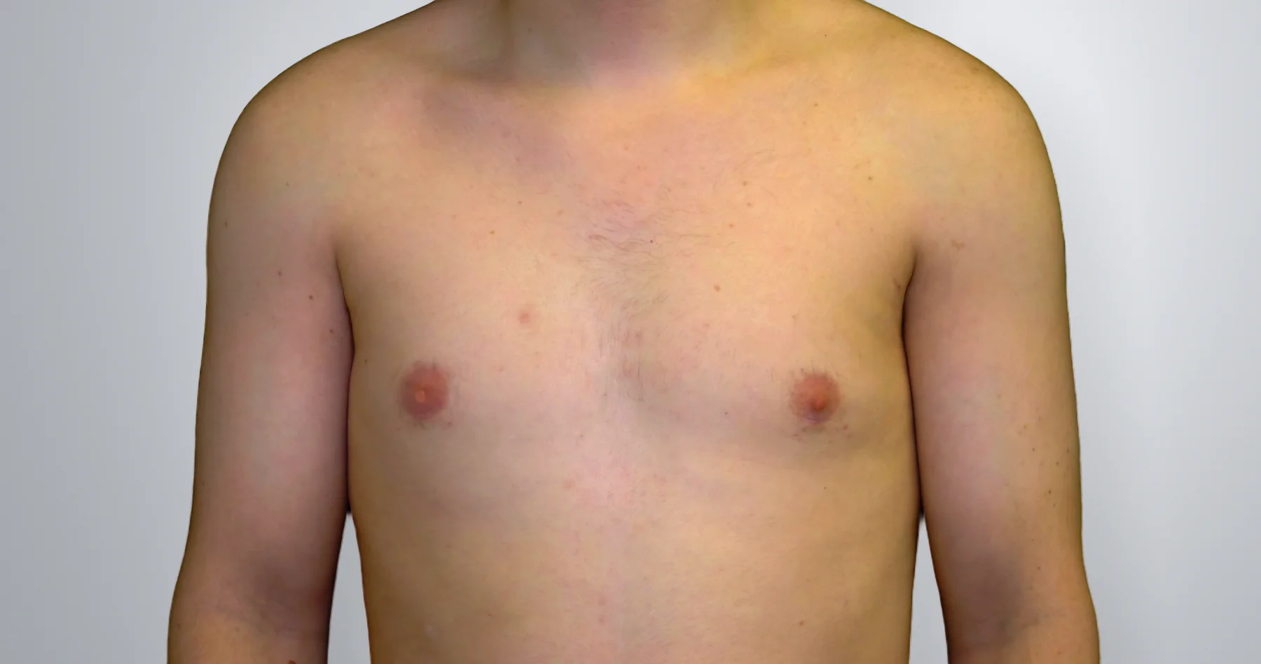 Gynecomastia + Liposuction after, Edition Plastic Surgery patient