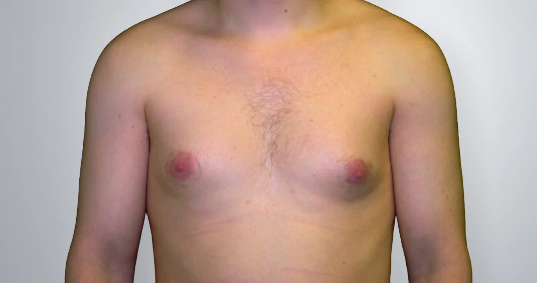 Gynecomastia + Liposuction before, Edition Plastic Surgery patient