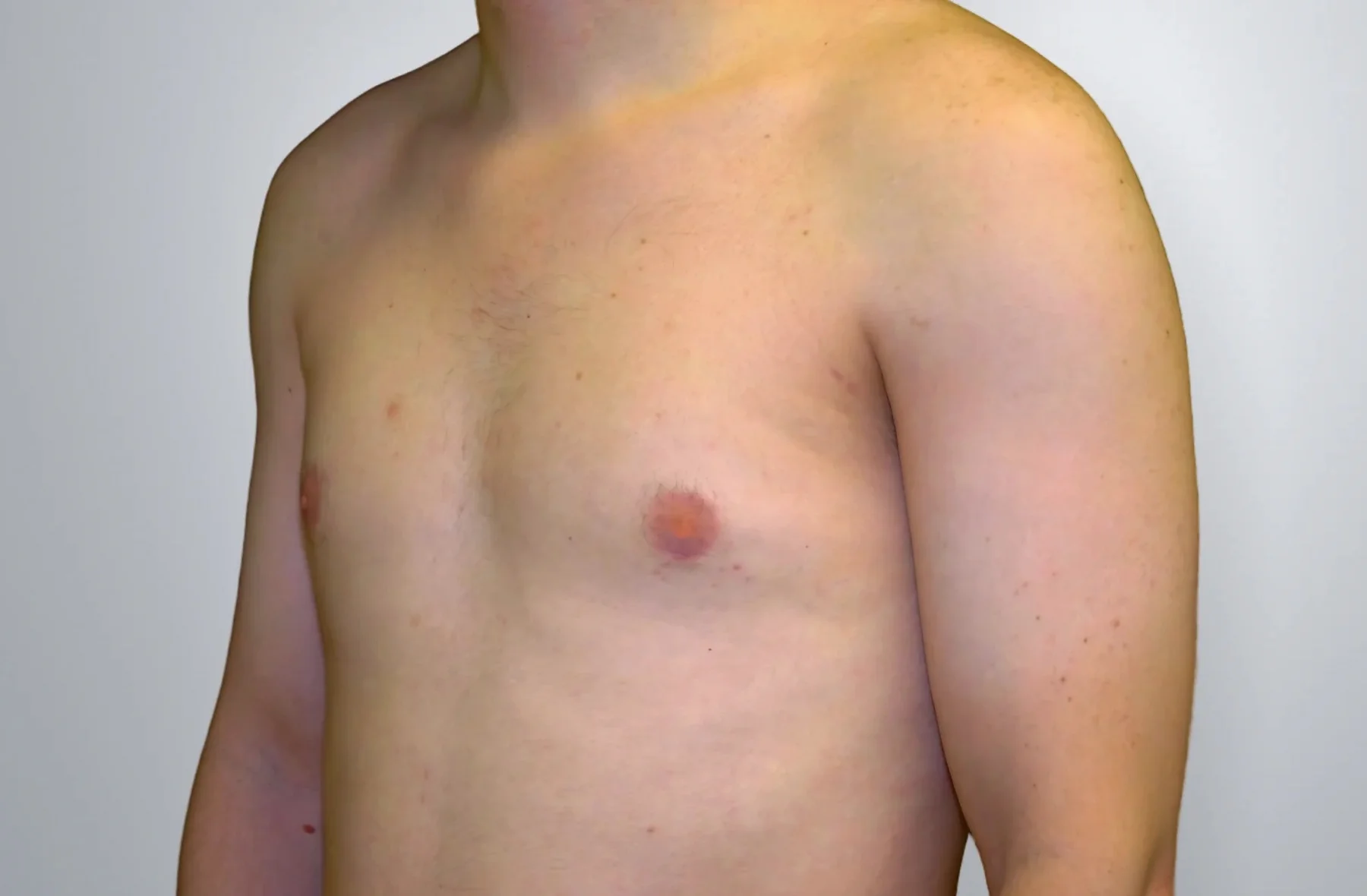 Gynecomastia + Liposuction after, Edition Plastic Surgery patient