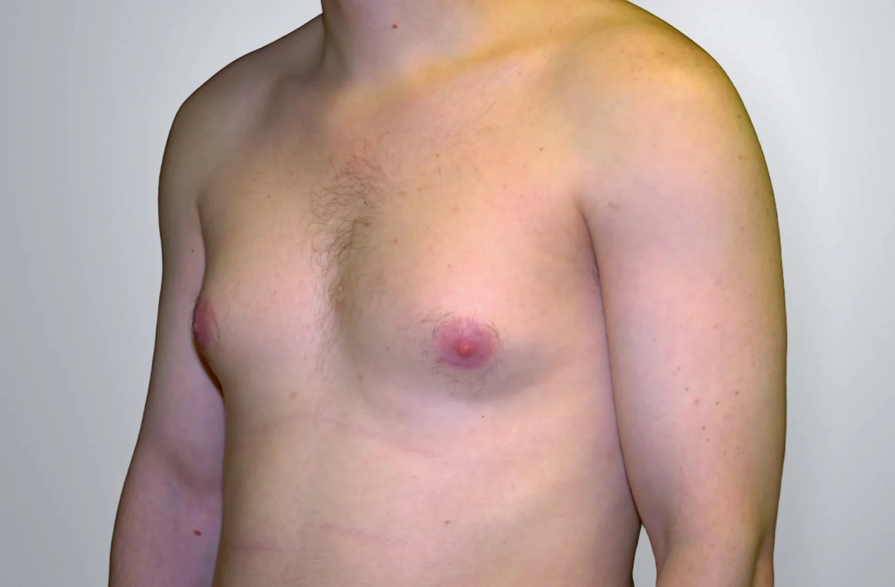 Gynecomastia + Liposuction before, Edition Plastic Surgery patient