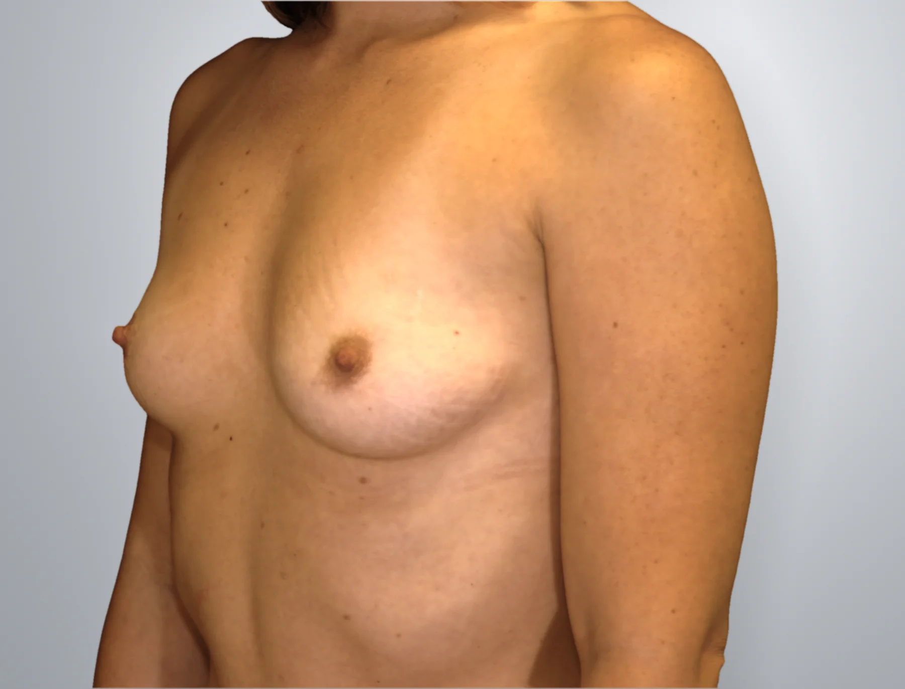 Breast Augmentation before, Edition Plastic Surgery patient