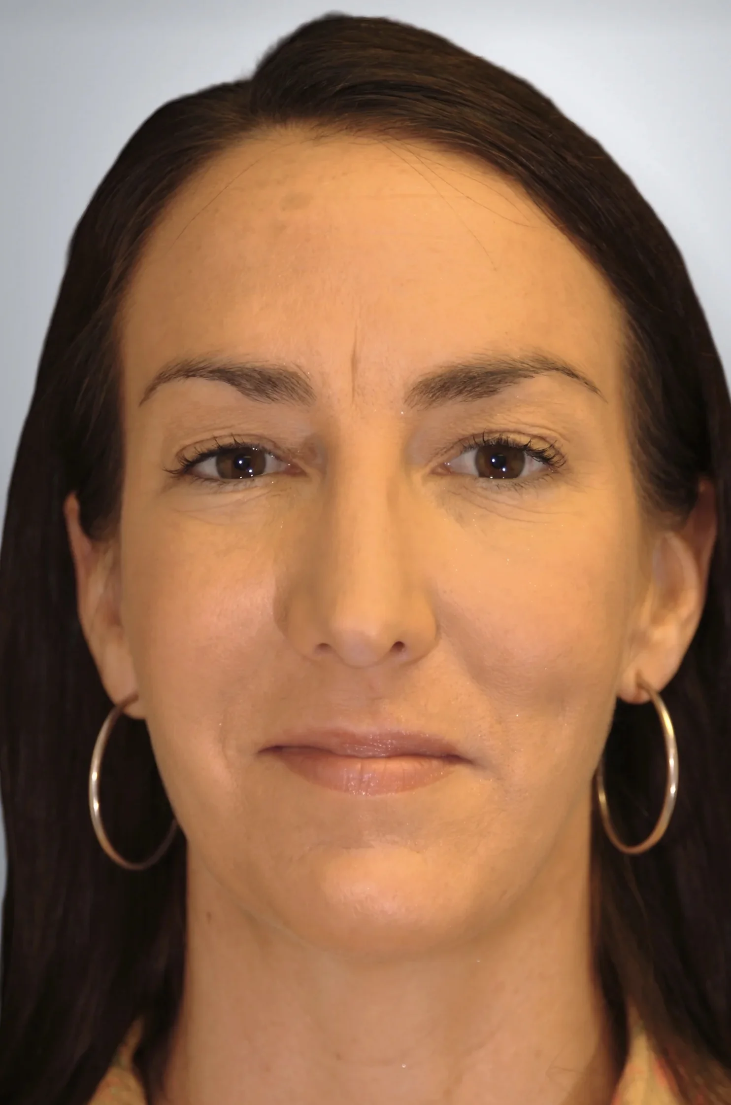 Midface Lift + Chin Augmentation after, Edition Plastic Surgery patient