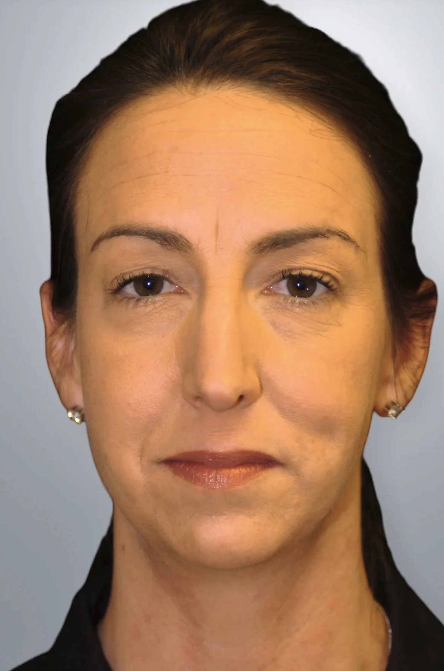 Midface Lift + Chin Augmentation before, Edition Plastic Surgery patient
