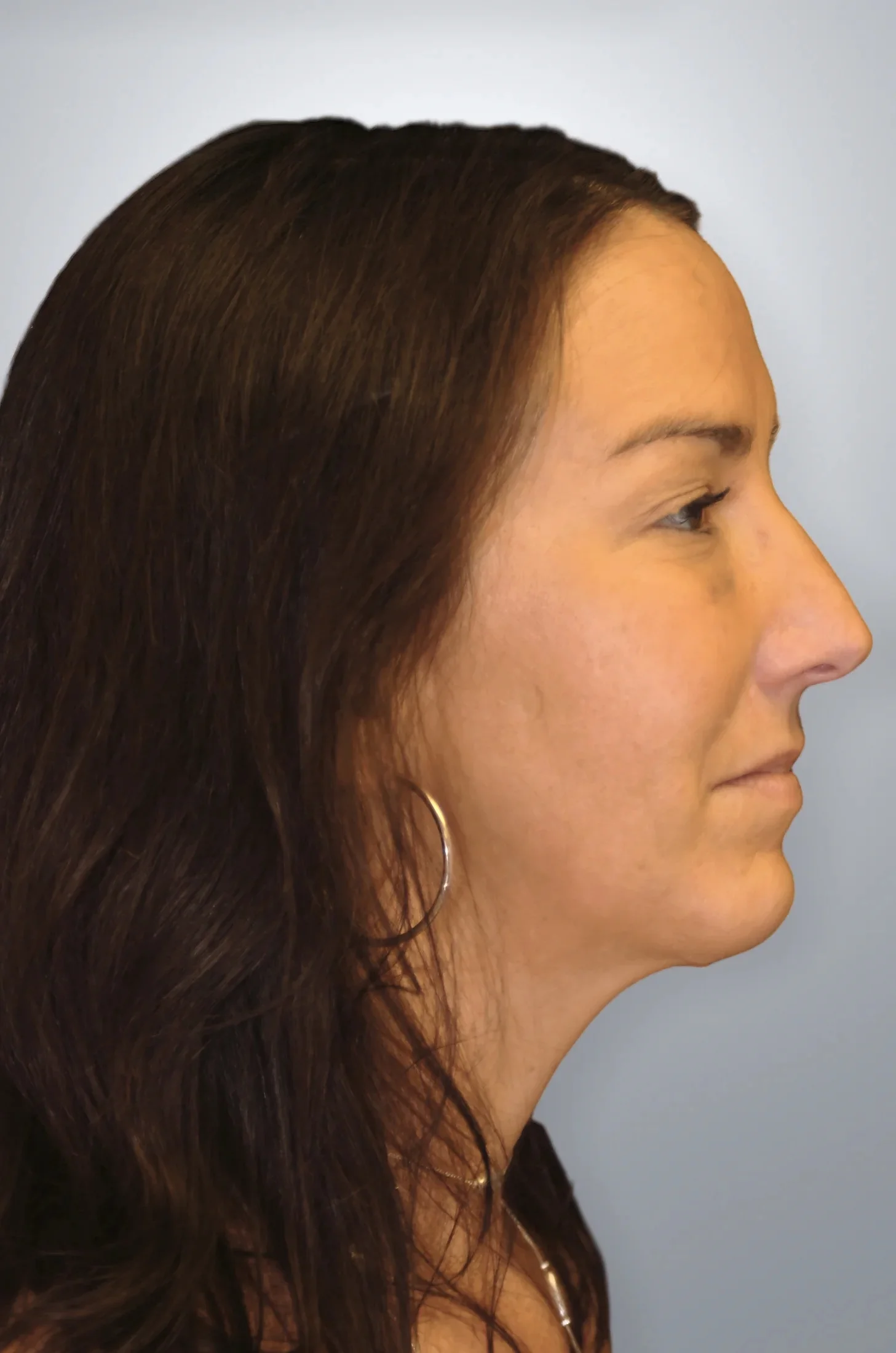 Cheek Augmentation + Midface Lift after — Edition Plastic Surgery patient