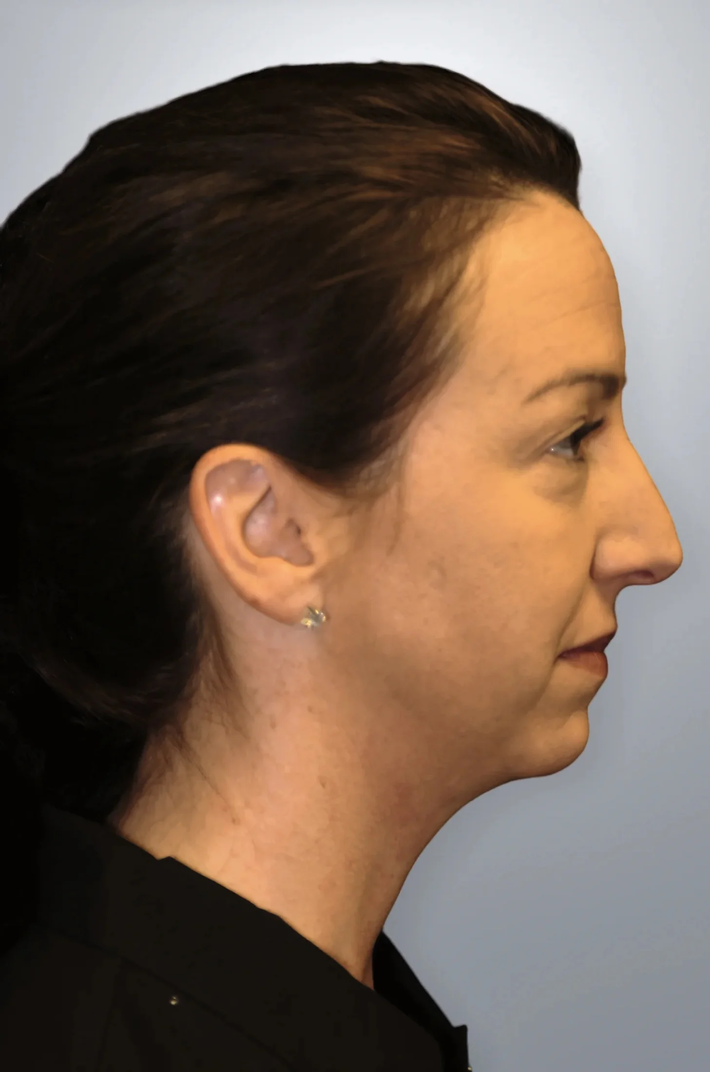 Cheek Augmentation + Midface Lift before — Edition Plastic Surgery patient