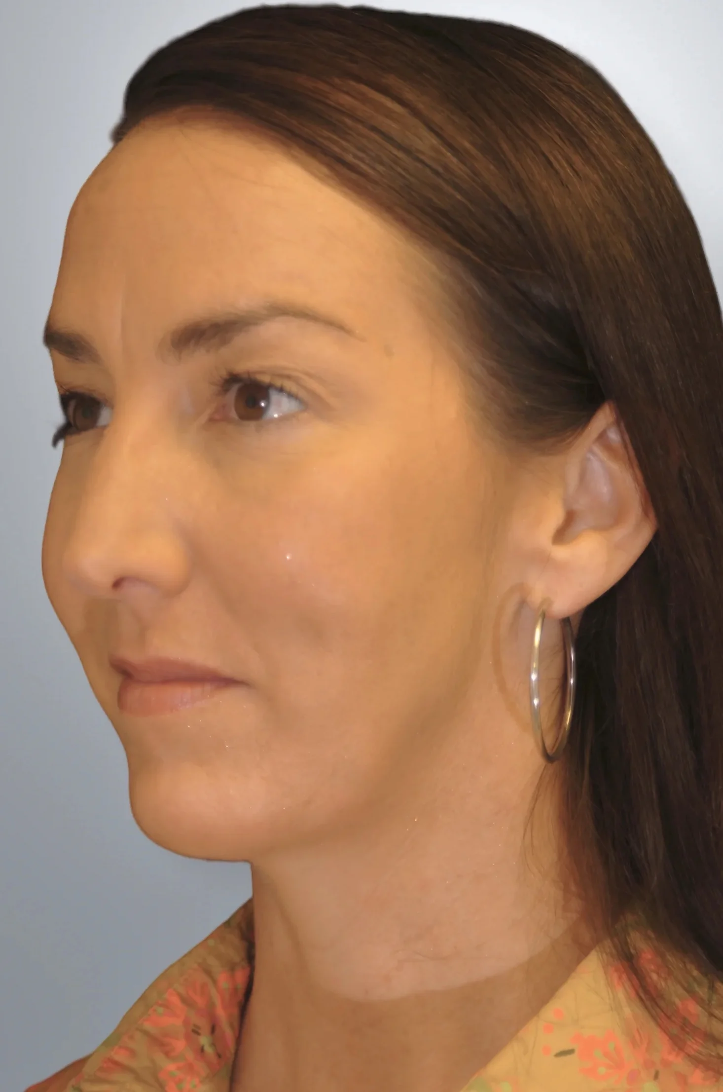 Chin Augmentation + Midface Lift after, Edition Plastic Surgery patient