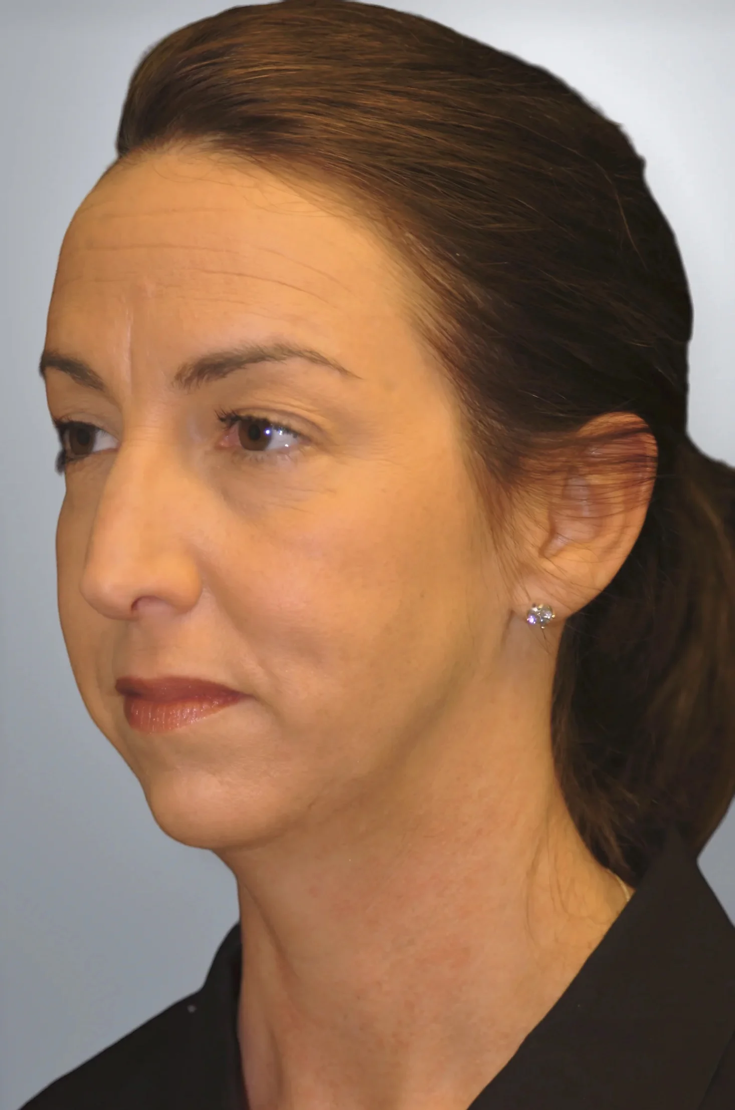 Chin Augmentation + Midface Lift before, Edition Plastic Surgery patient