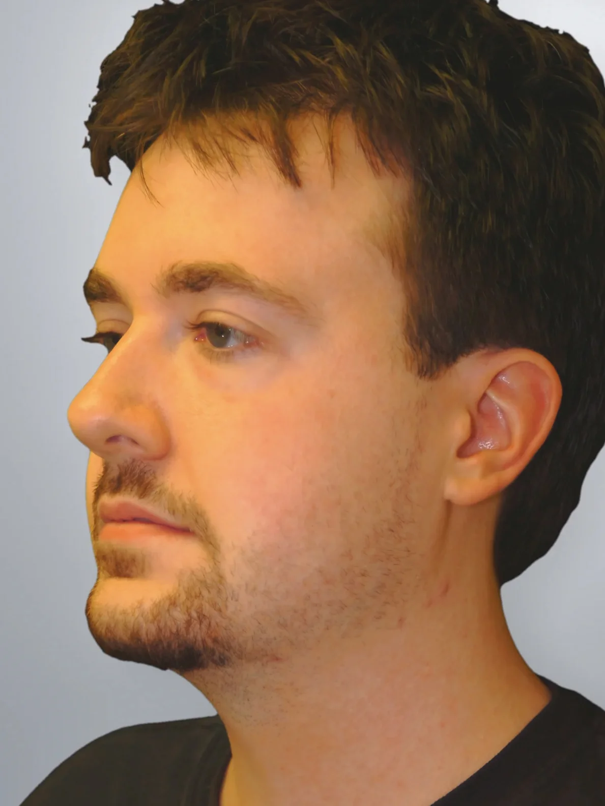 Liposuction after, Edition Plastic Surgery patient