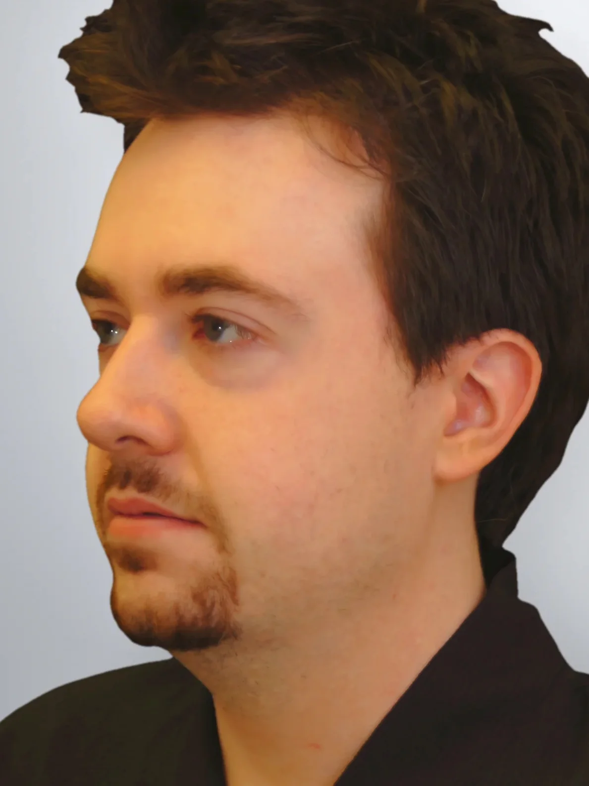 Liposuction before, Edition Plastic Surgery patient