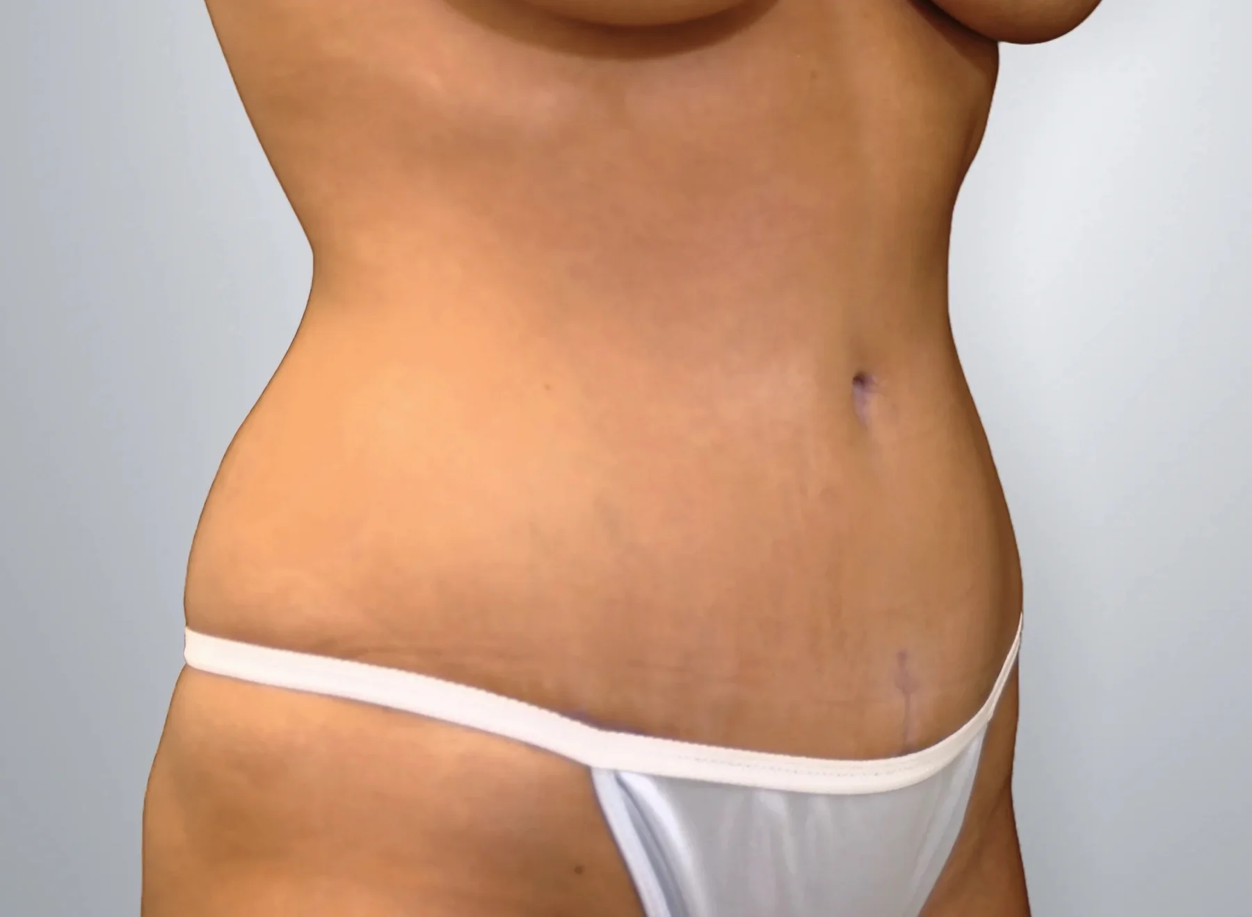 Tummy Tuck after, Edition Plastic Surgery patient