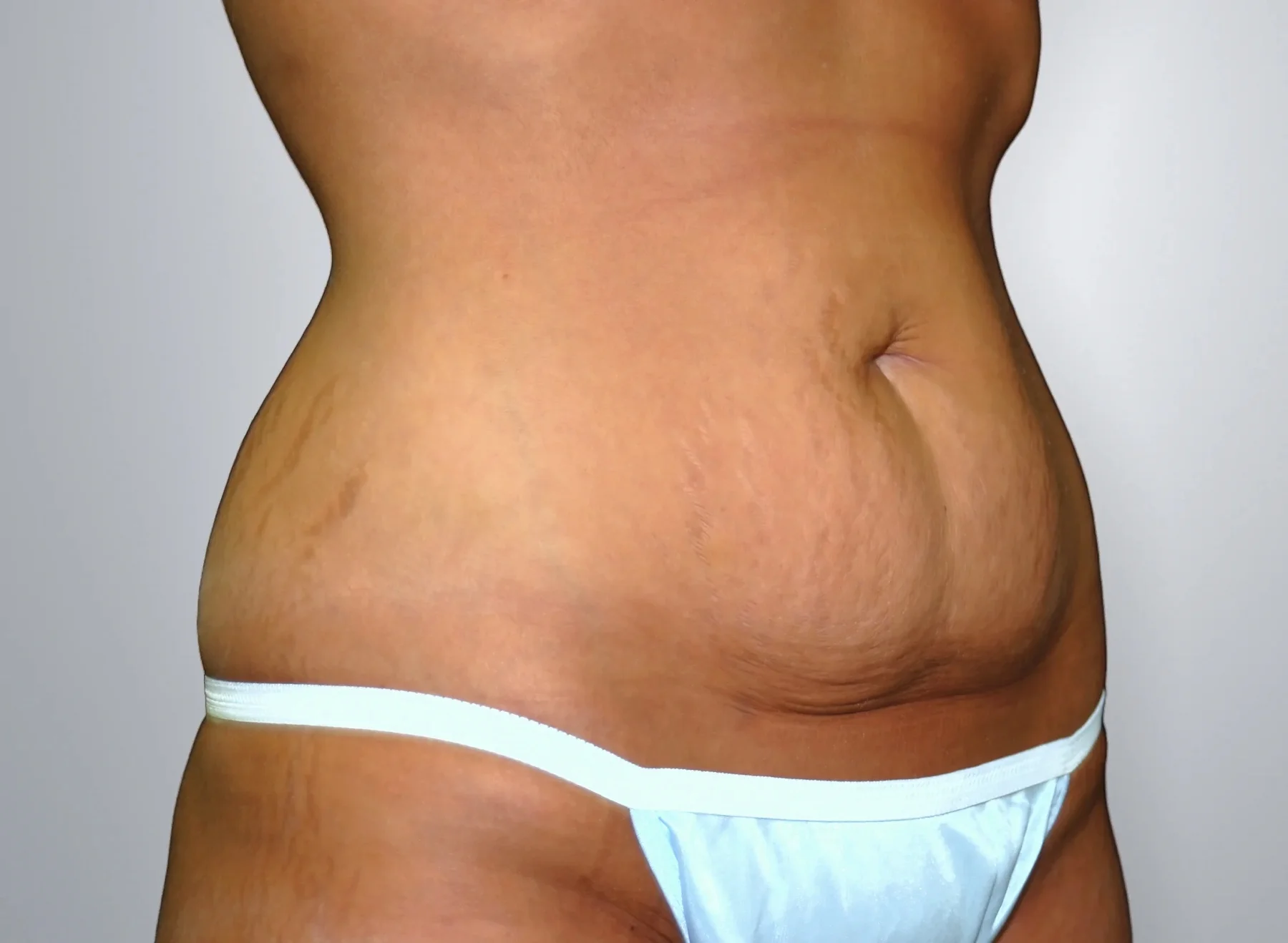 Tummy Tuck before, Edition Plastic Surgery patient