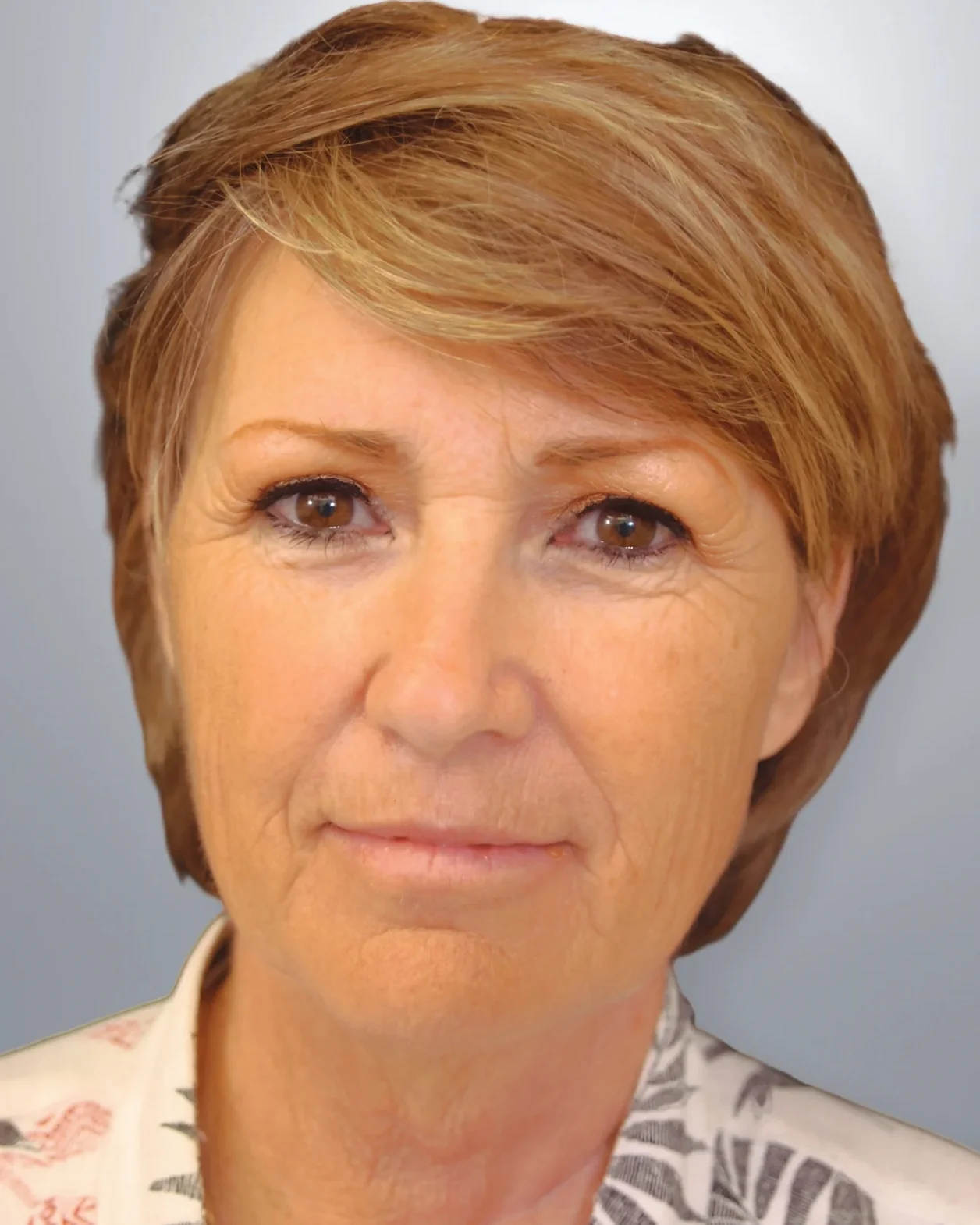 Midface Lift + Facelift + Neck Lift before, Edition Plastic Surgery patient
