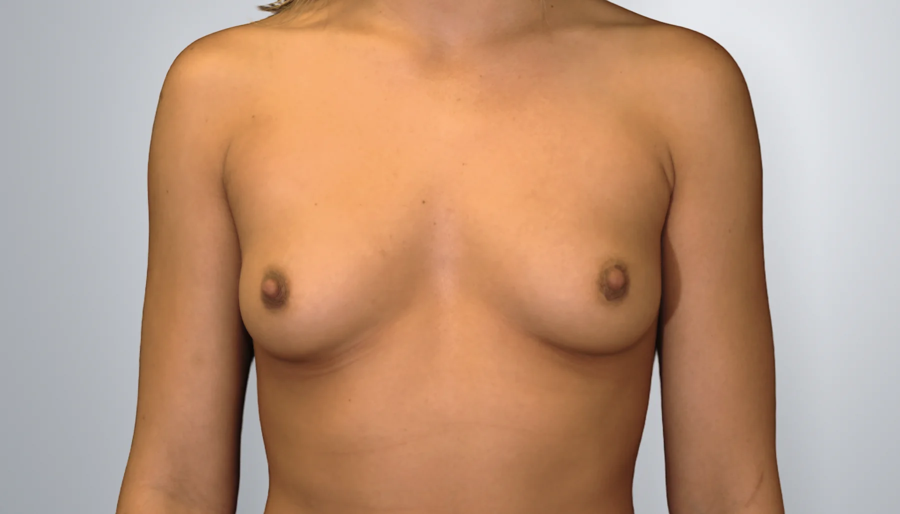 Breast Augmentation before, Edition Plastic Surgery patient