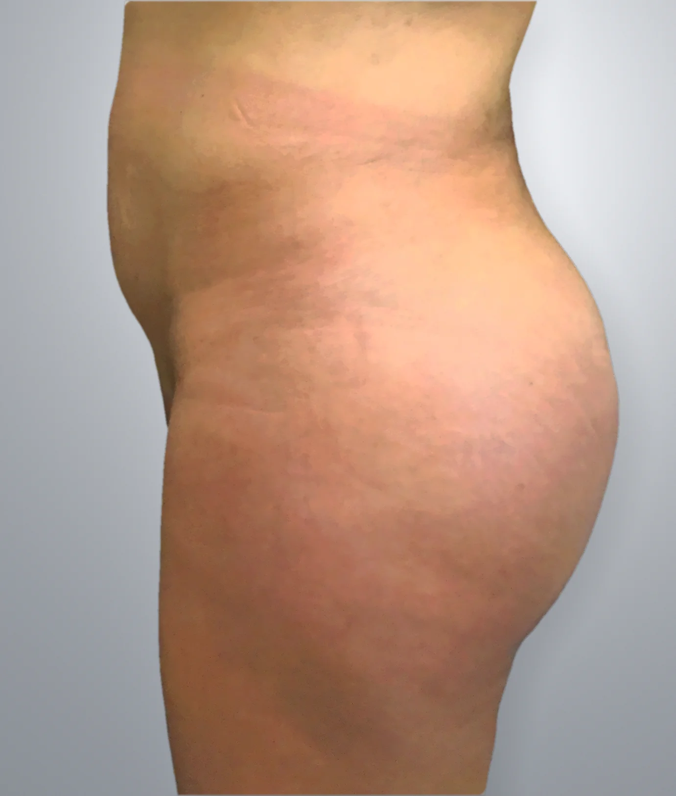 Brazilian Butt Lift after — Edition Plastic Surgery patient