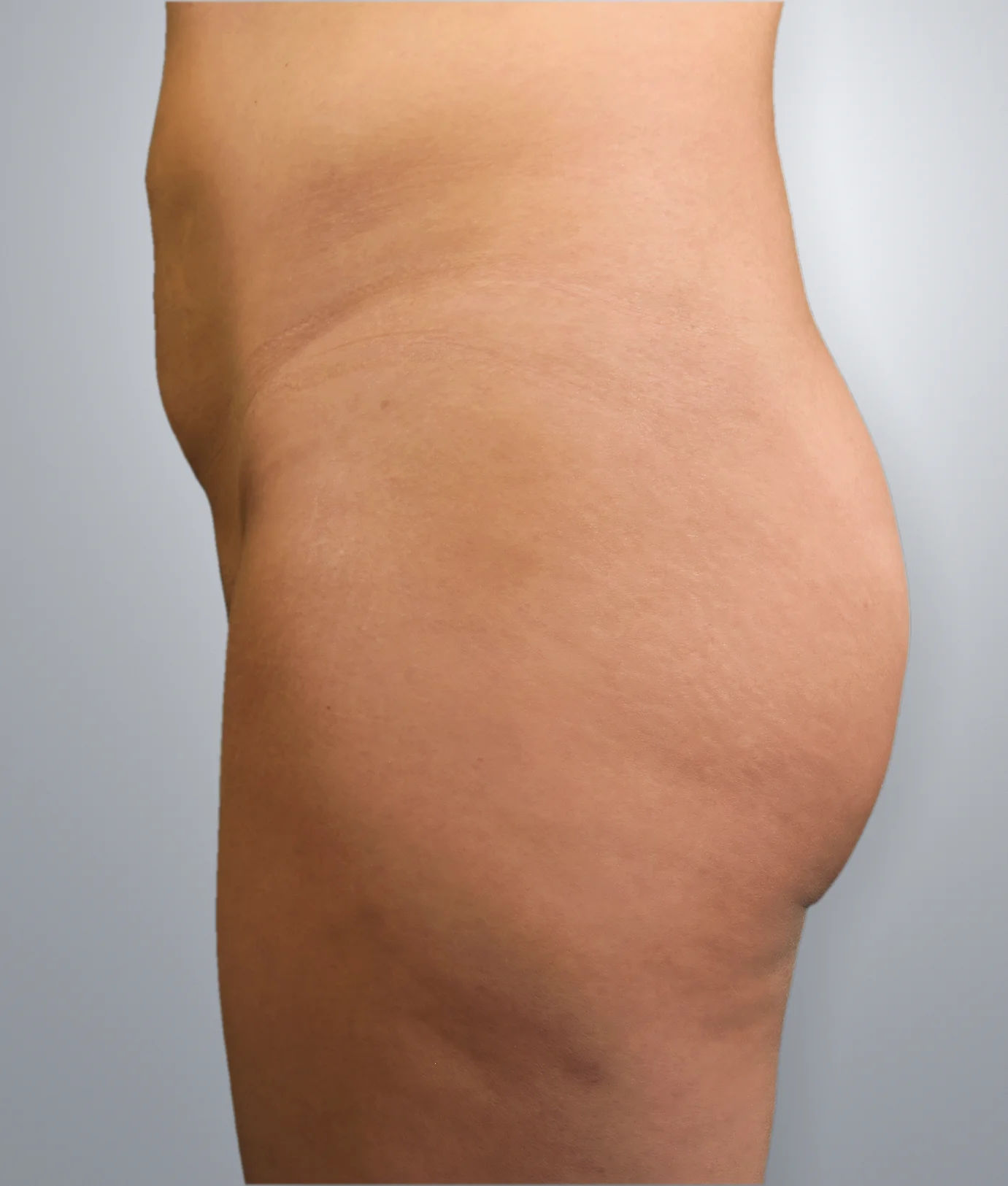 Brazilian Butt Lift before — Edition Plastic Surgery patient