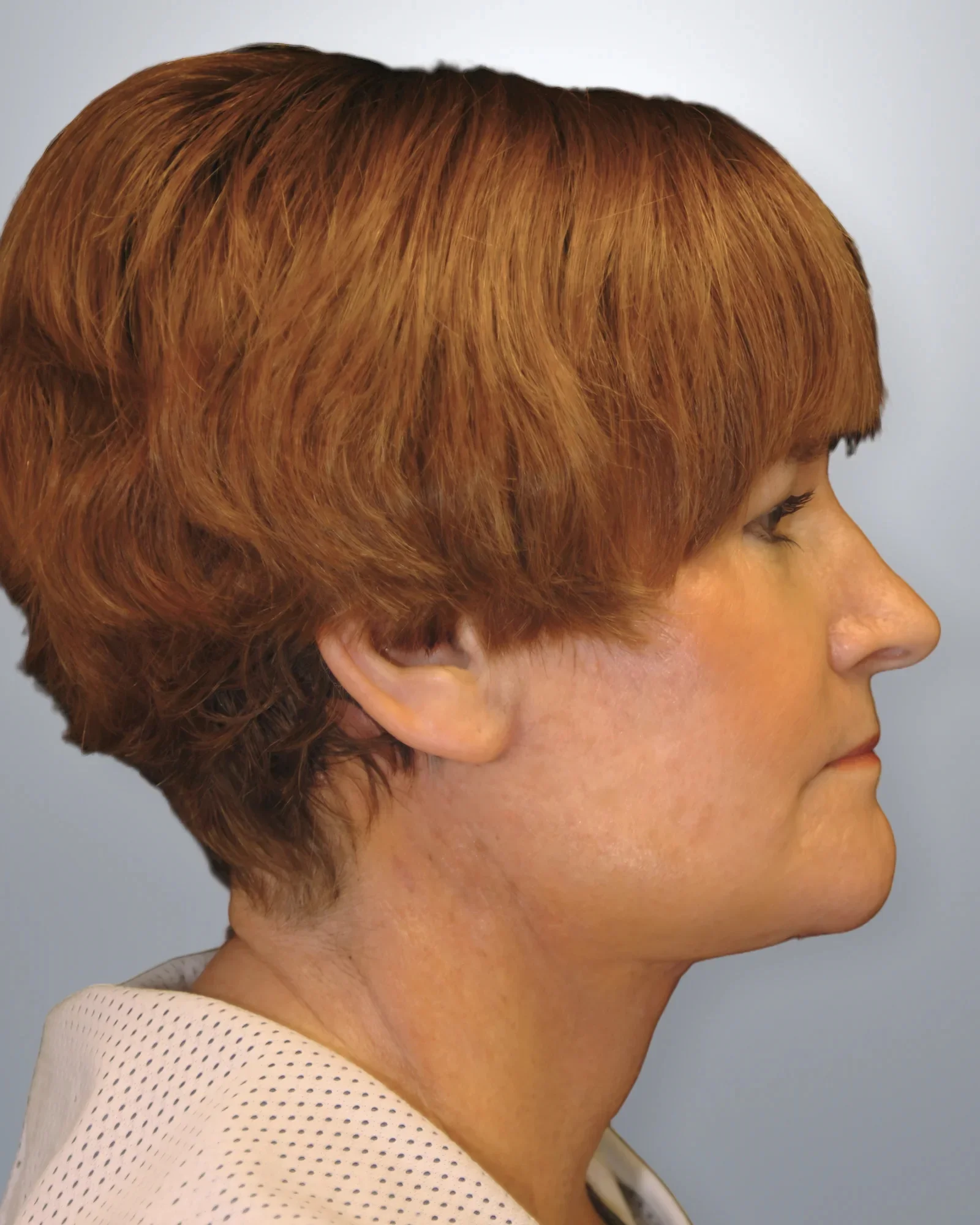 Neck Lift after, Edition Plastic Surgery patient