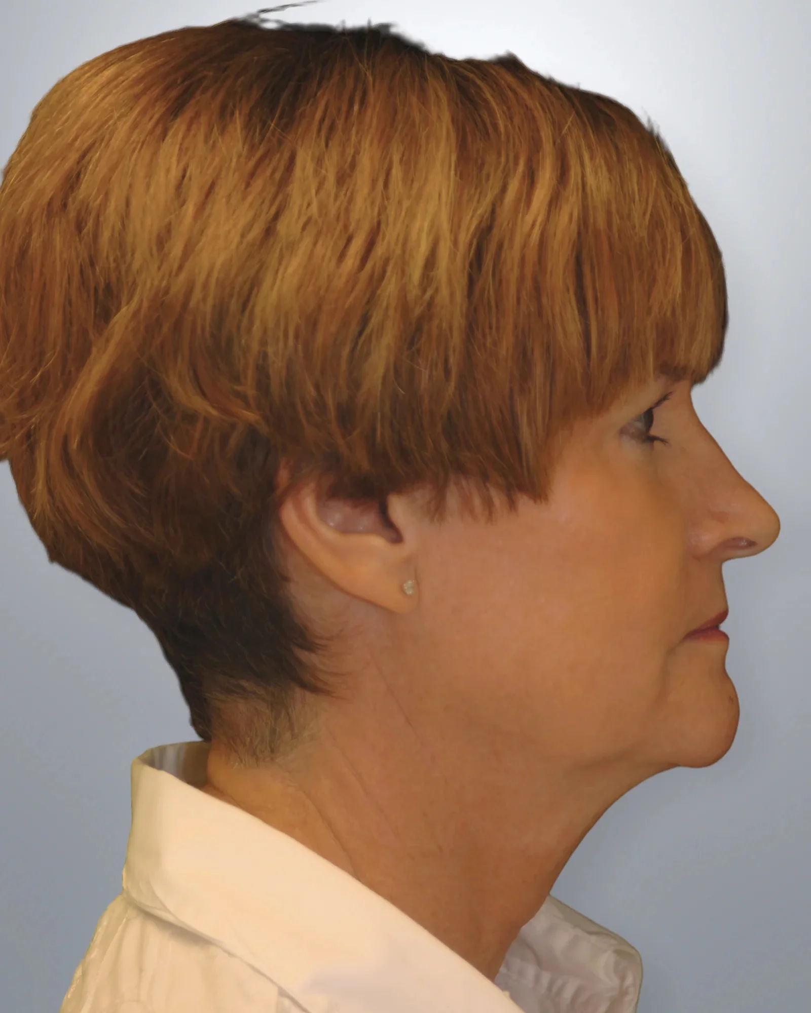 Neck Lift before, Edition Plastic Surgery patient