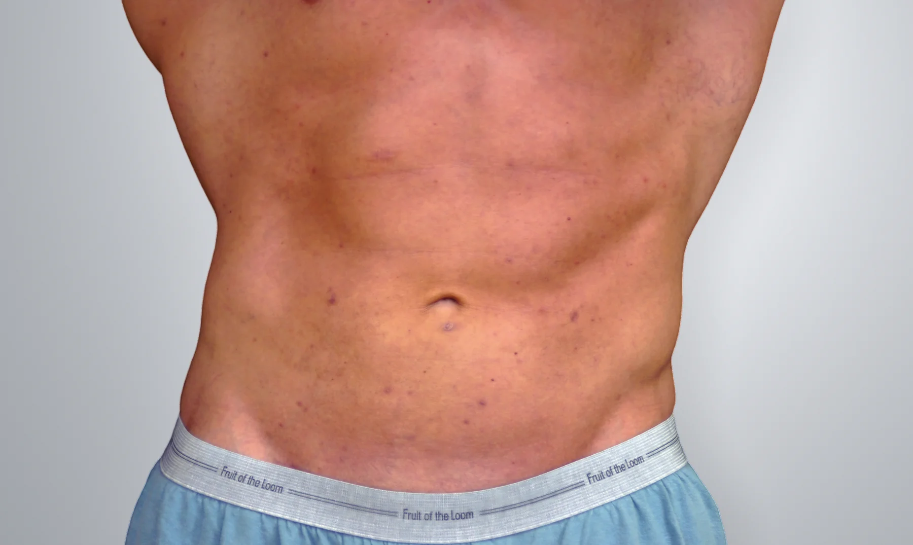 Liposuction after, Edition Plastic Surgery patient