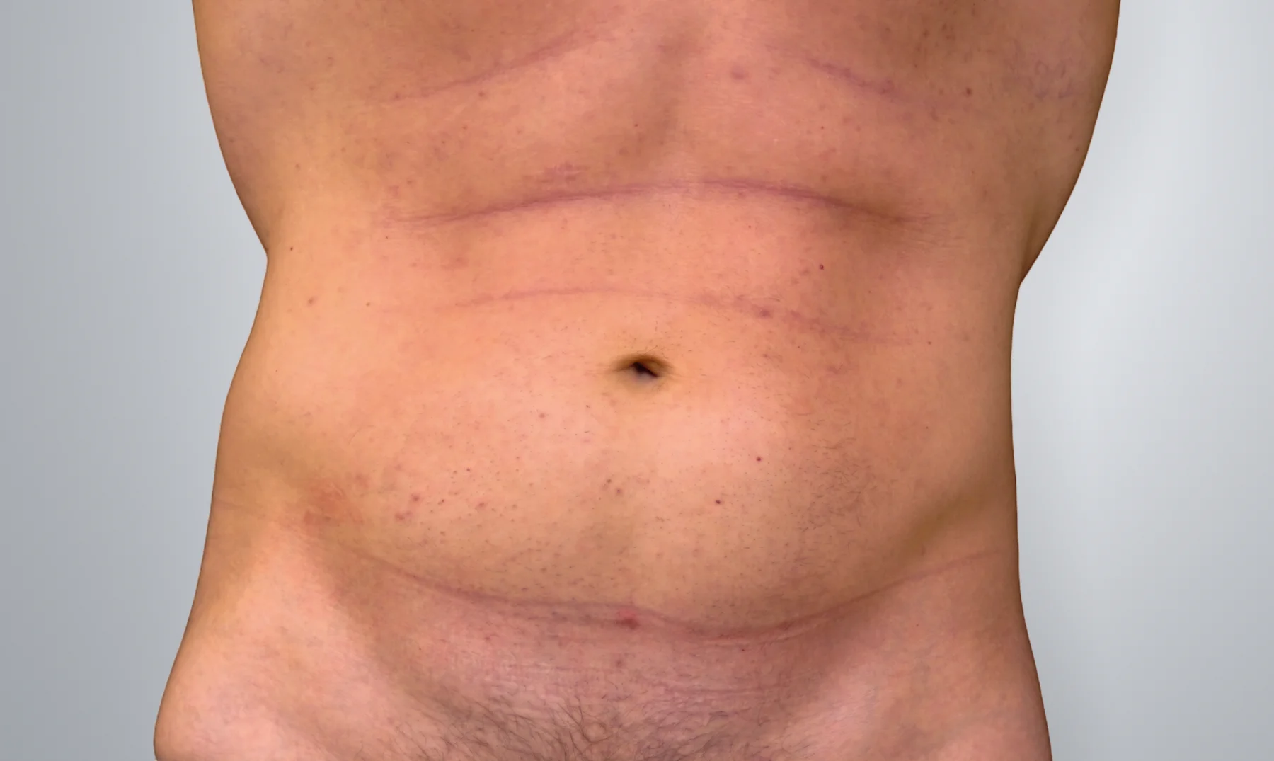 Liposuction before, Edition Plastic Surgery patient