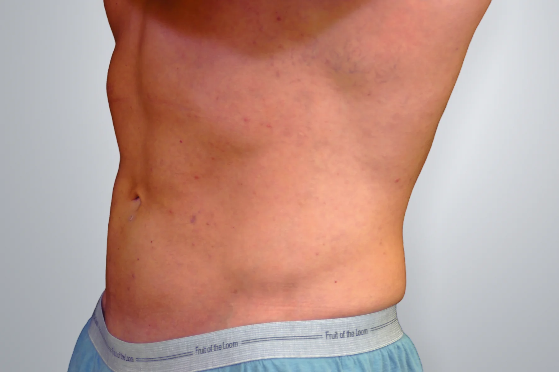 Liposuction after, Edition Plastic Surgery patient