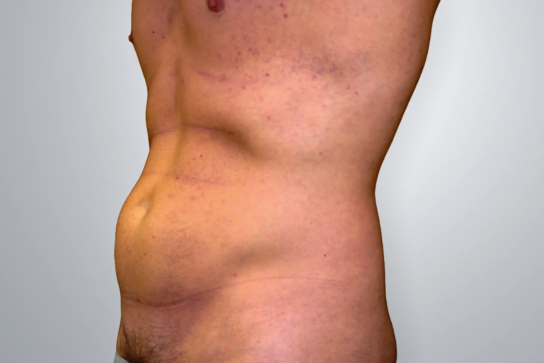 Liposuction before, Edition Plastic Surgery patient