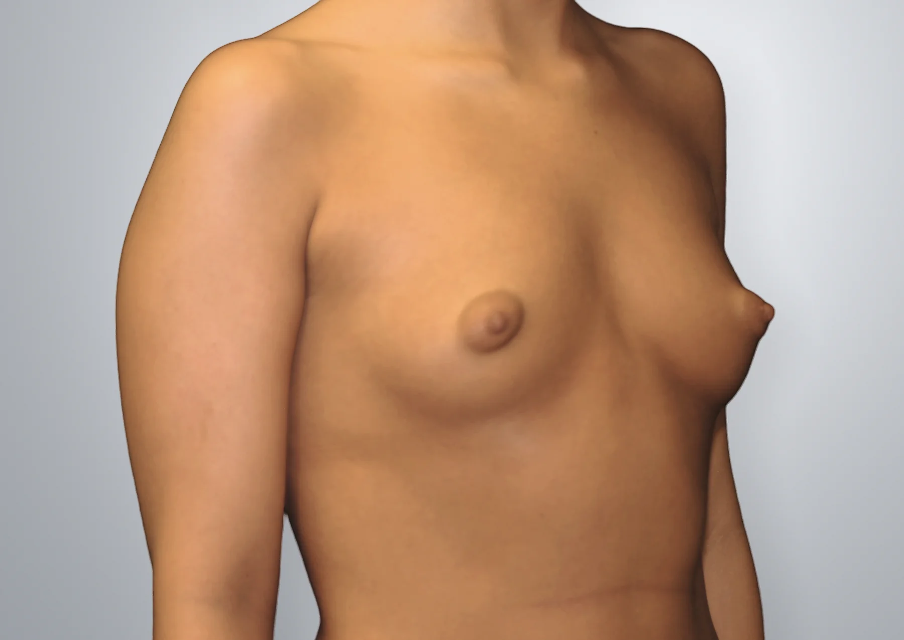 Breast Augmentation before, Edition Plastic Surgery patient
