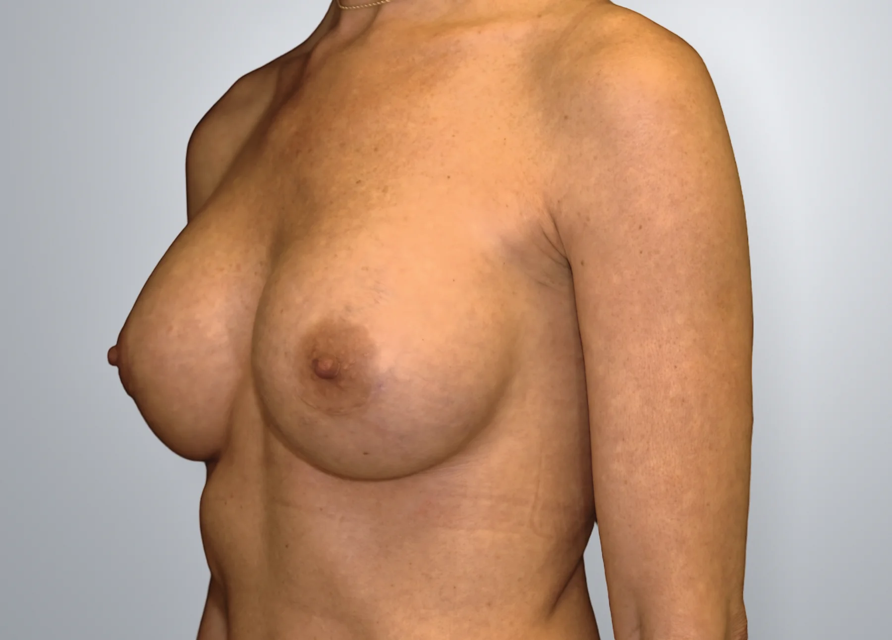 Breast Implant Revision after, Edition Plastic Surgery patient