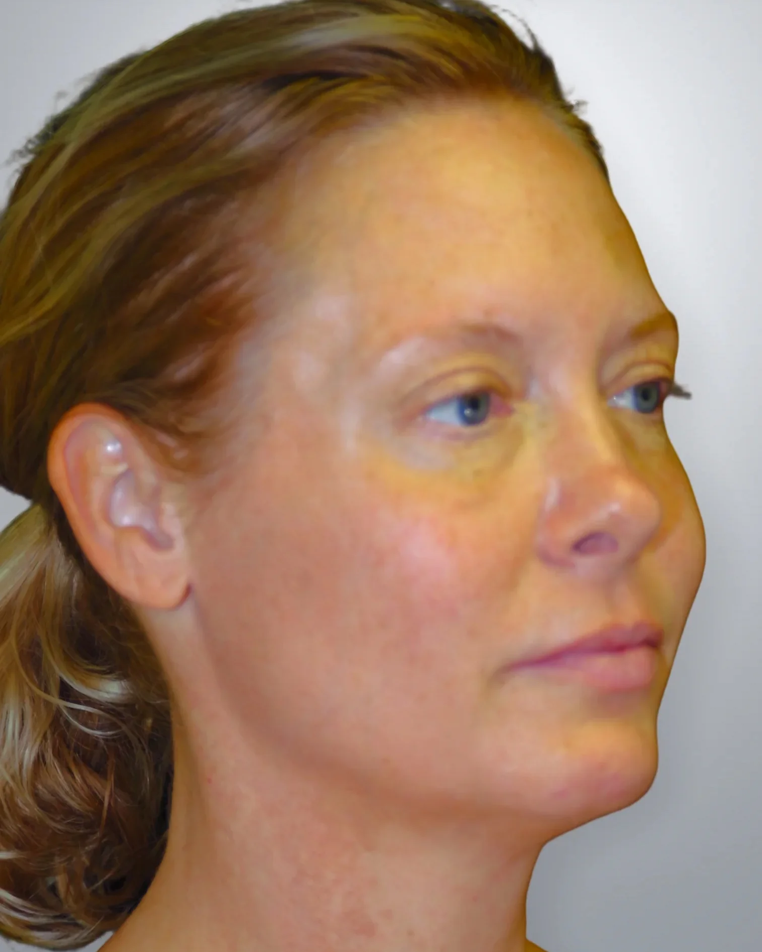 Midface Lift after — Edition Plastic Surgery patient