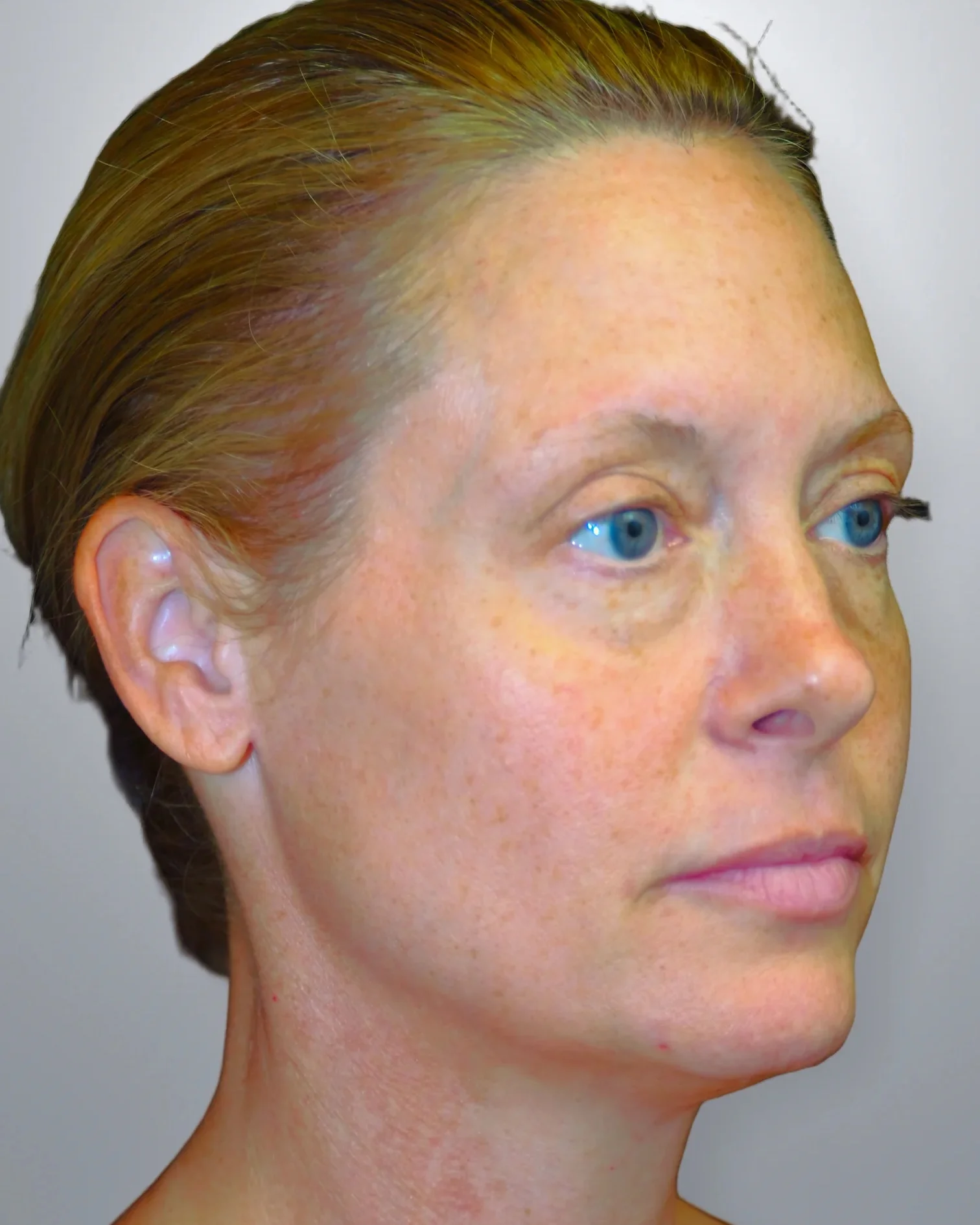 Midface Lift before — Edition Plastic Surgery patient