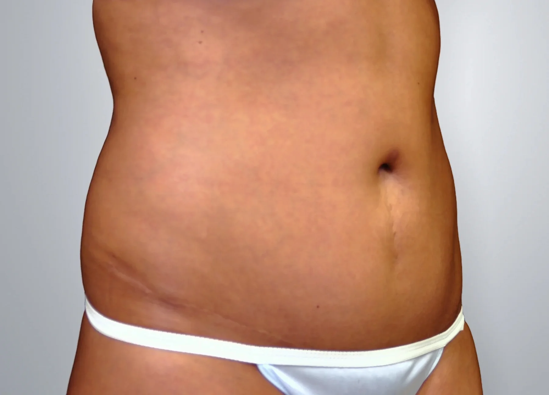 Tummy Tuck after, Edition Plastic Surgery patient